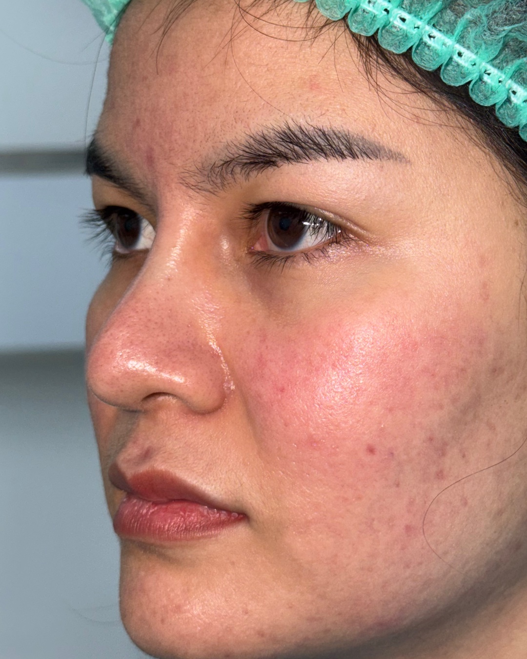 Before revision rhinoplasty with costal cartilage grafting, left oblique view, Case 019