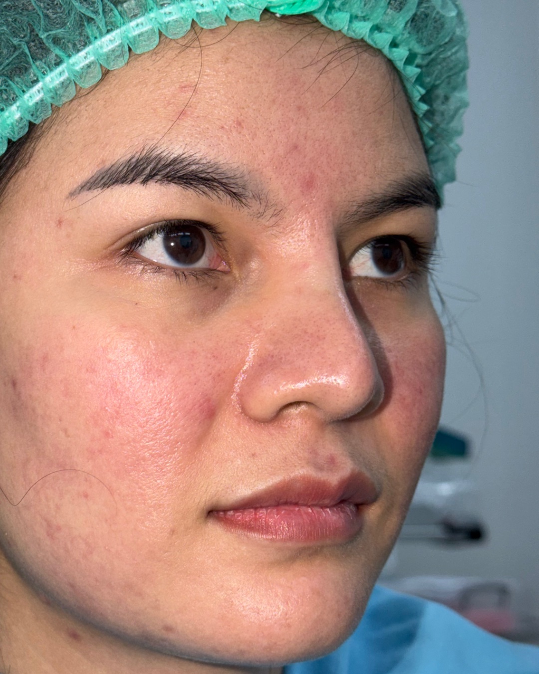Before revision rhinoplasty with costal cartilage grafting, right oblique view, Case 019