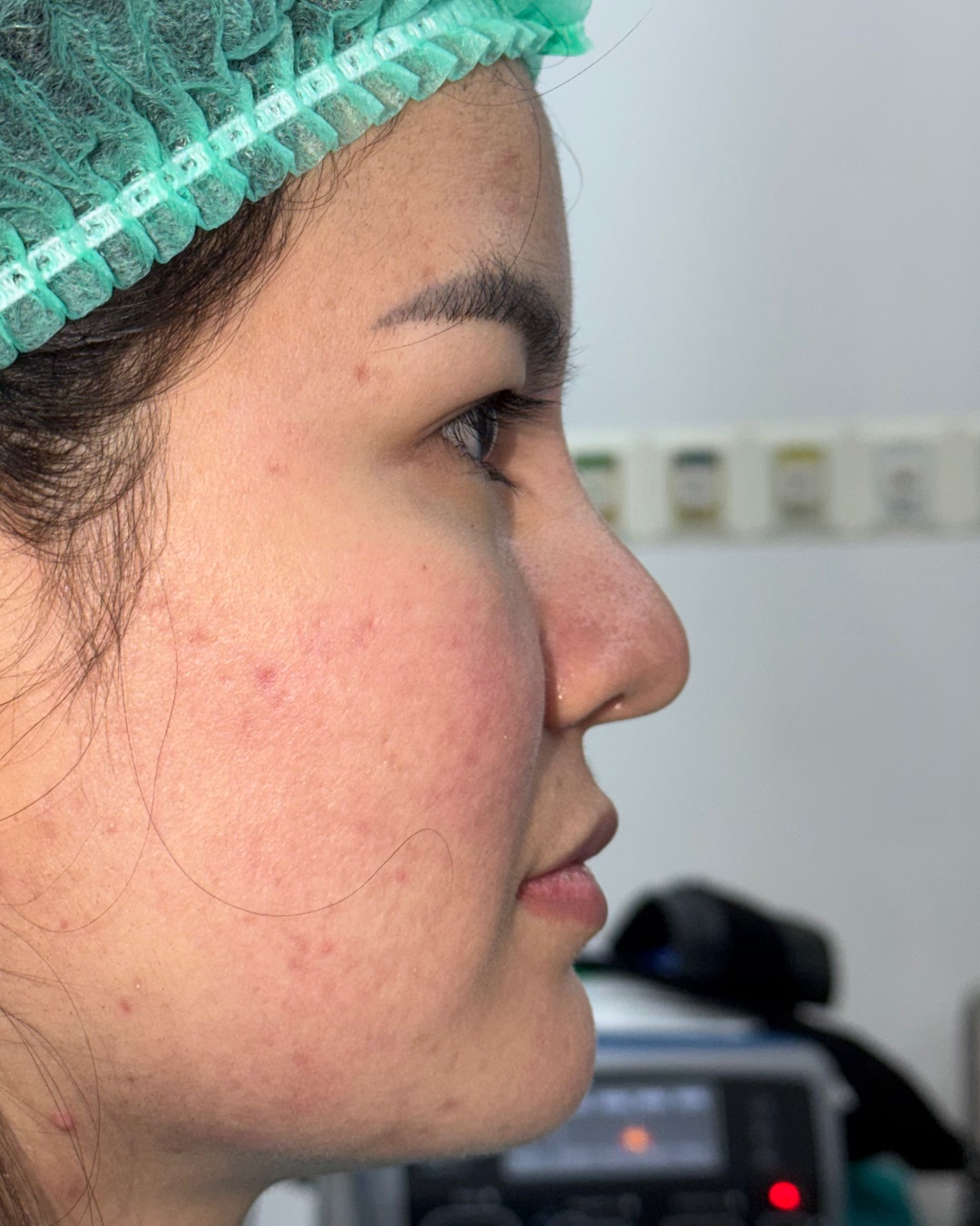 Before revision rhinoplasty with costal cartilage grafting, right profile view, Case 019