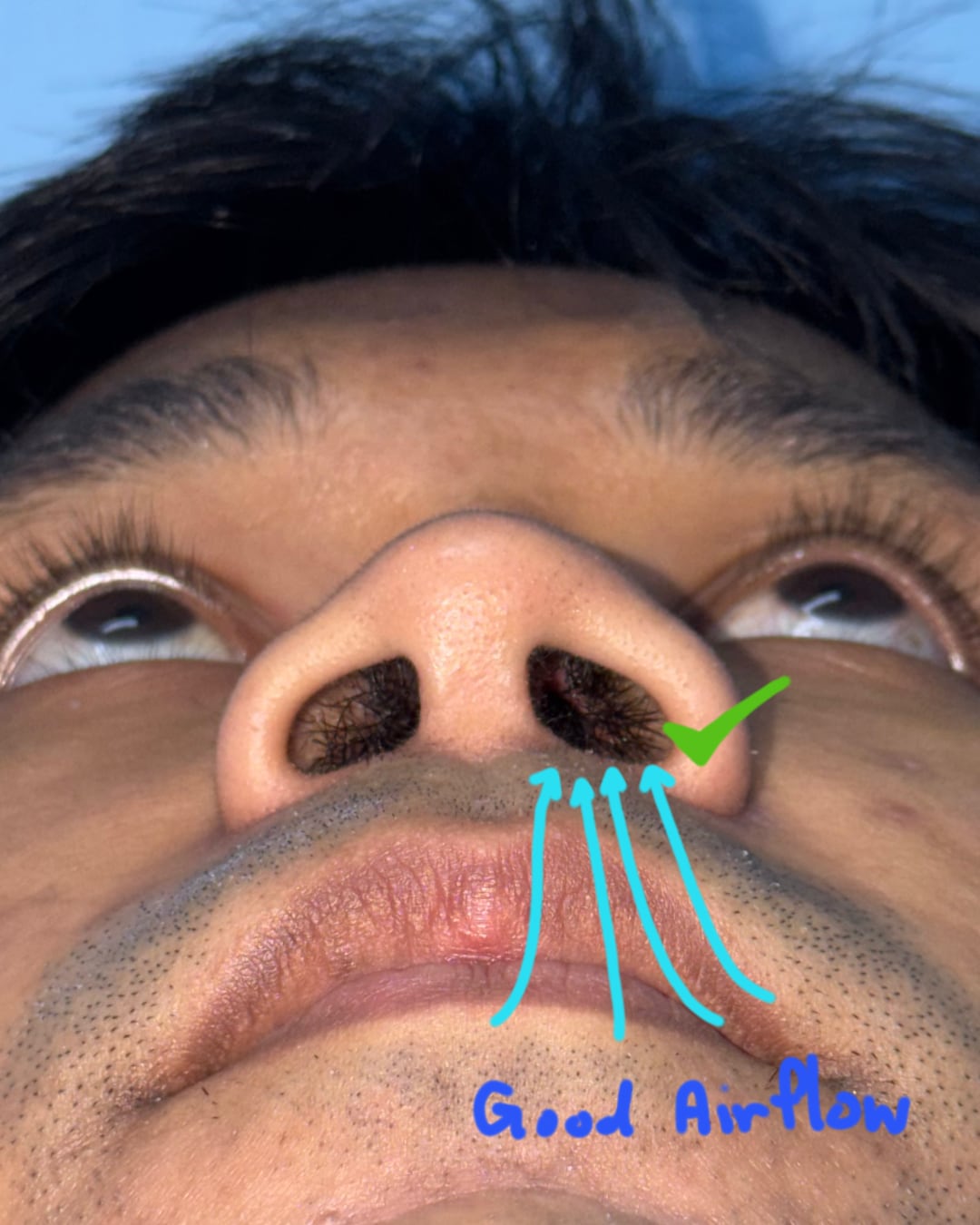 One-year postoperative basal functional airflow view, Case 020