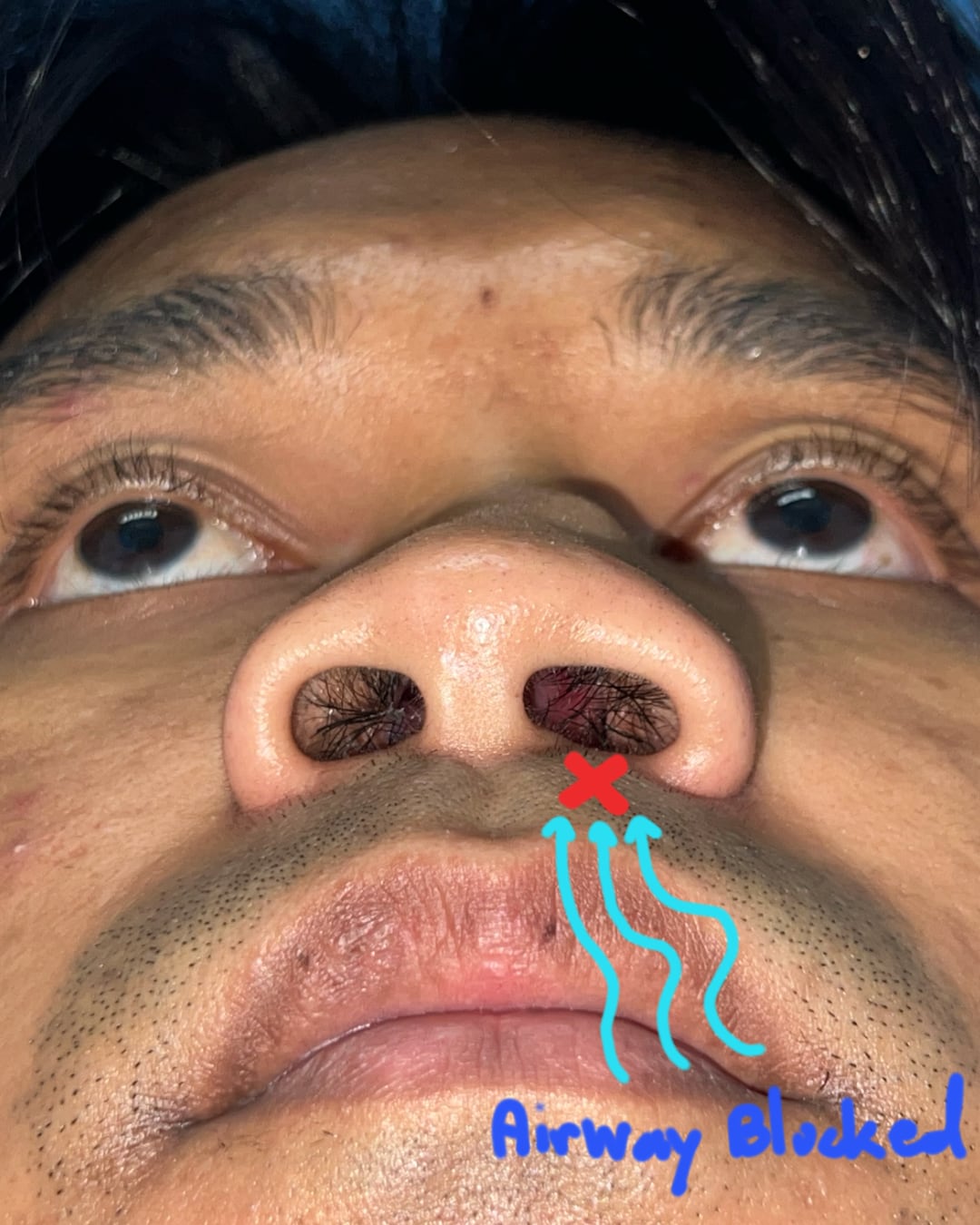 Preoperative basal functional airflow view, Case 020
