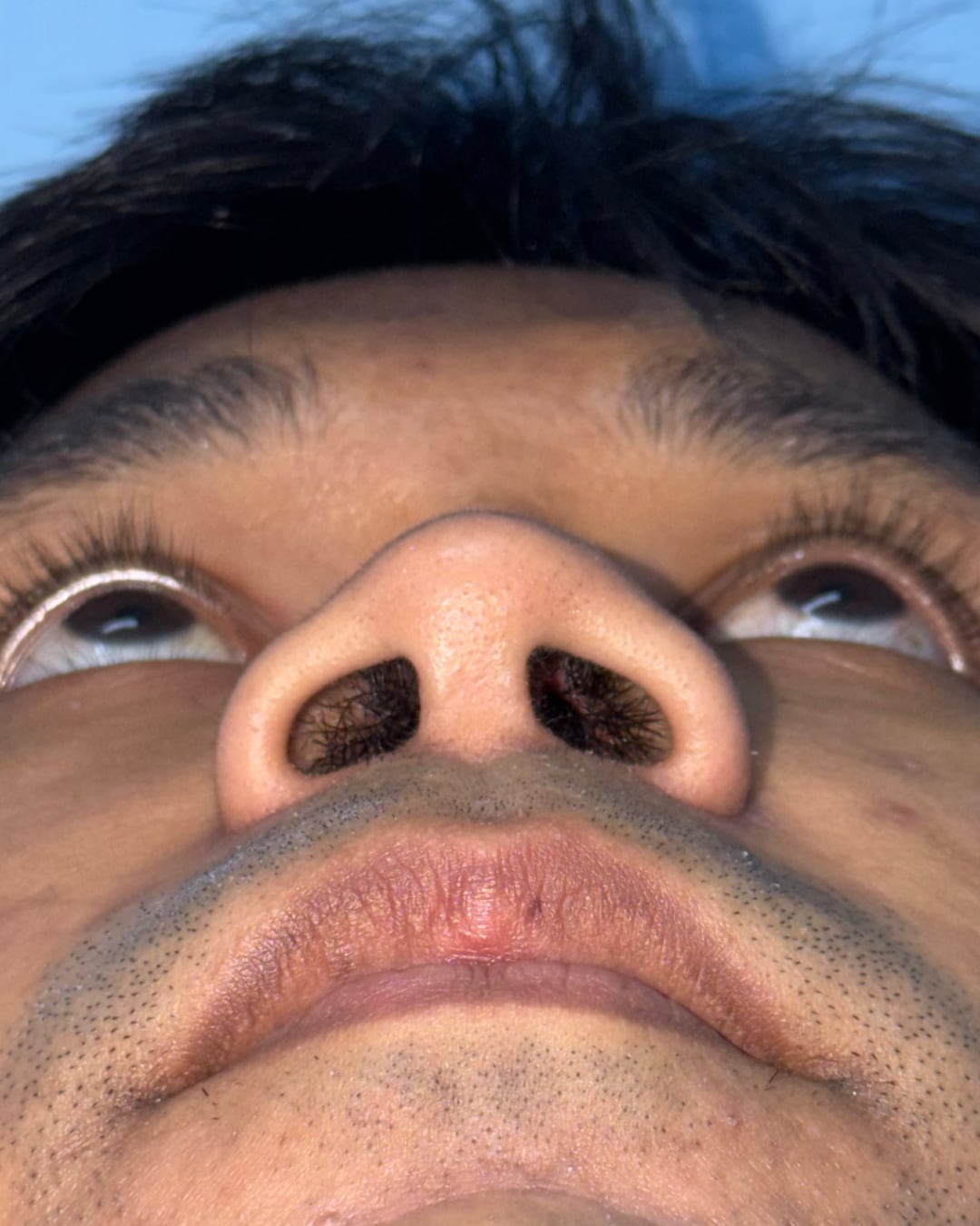 One year after primary open rhinoplasty with costal cartilage grafting, base view, Case 020