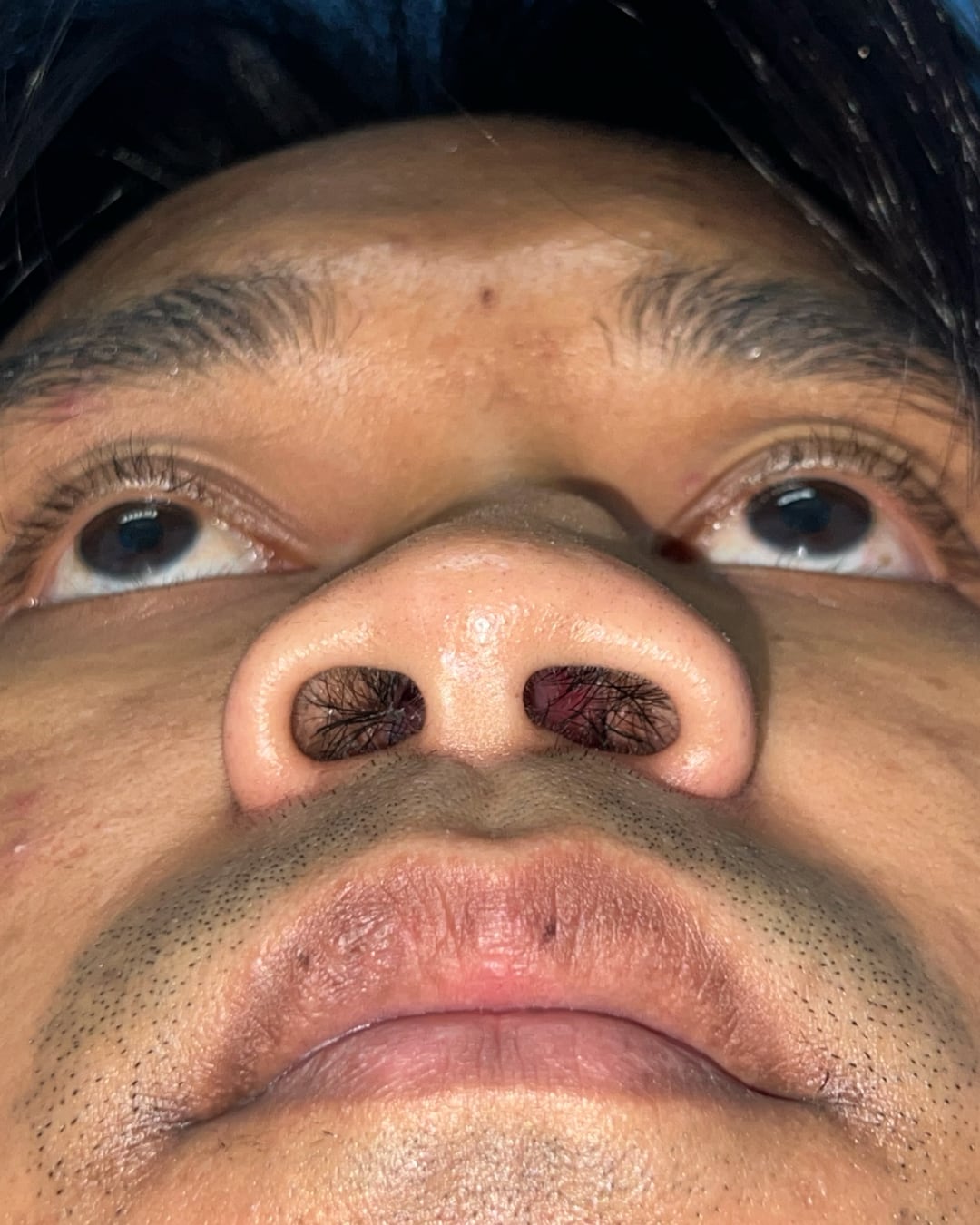 Before primary rhinoplasty for severe congenital nasal deviation, base view, Case 020