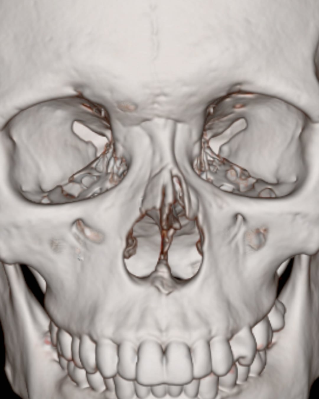 One-year postoperative three-dimensional CT reconstruction, Case 020