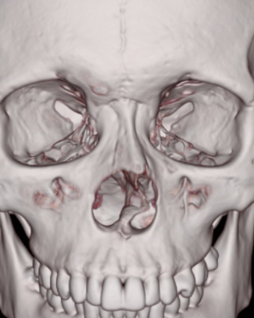 Preoperative three-dimensional CT reconstruction, Case 020
