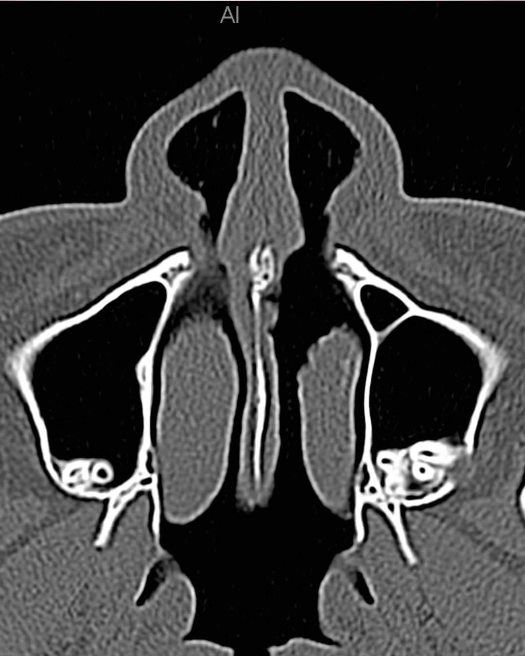 One-year postoperative axial CT view, Case 020