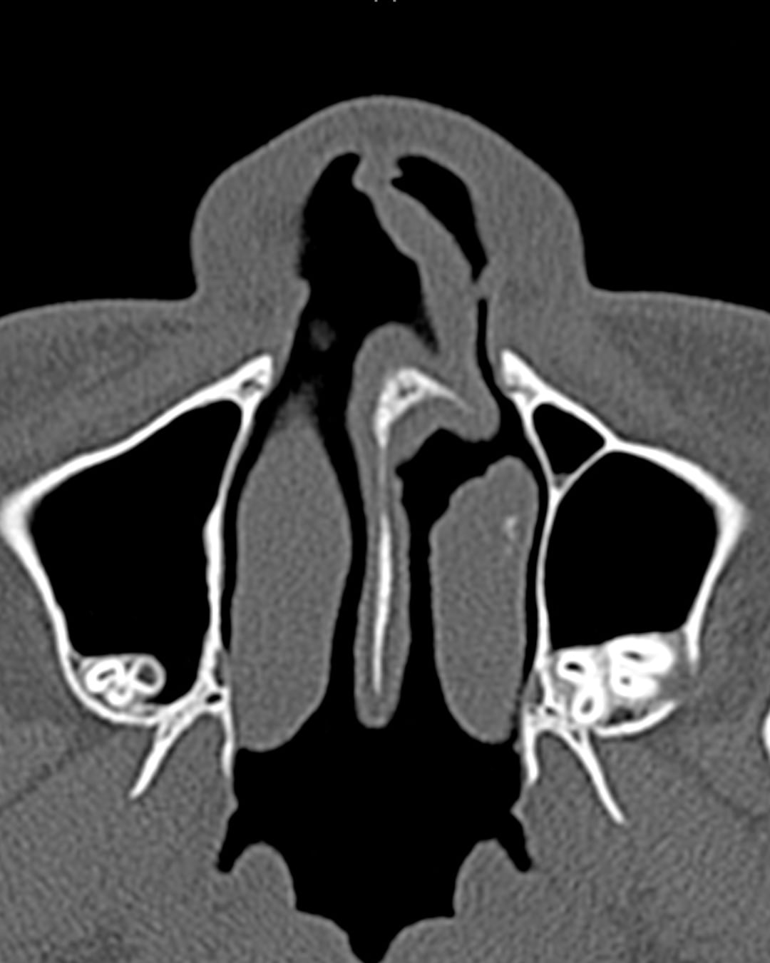 Preoperative axial CT view, Case 020