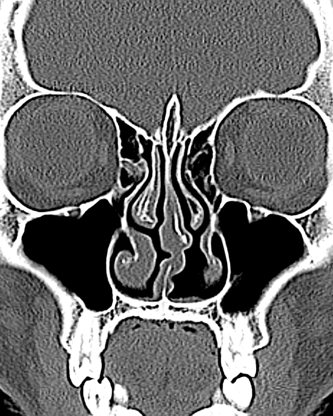One-year postoperative coronal CT view, Case 020
