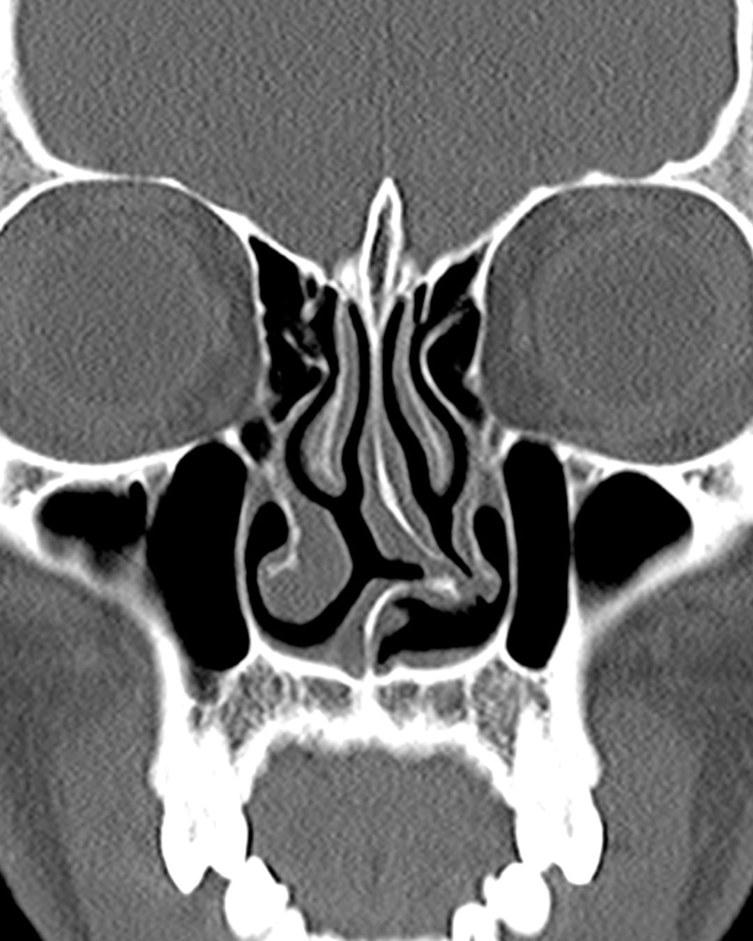 Preoperative coronal CT view, Case 020