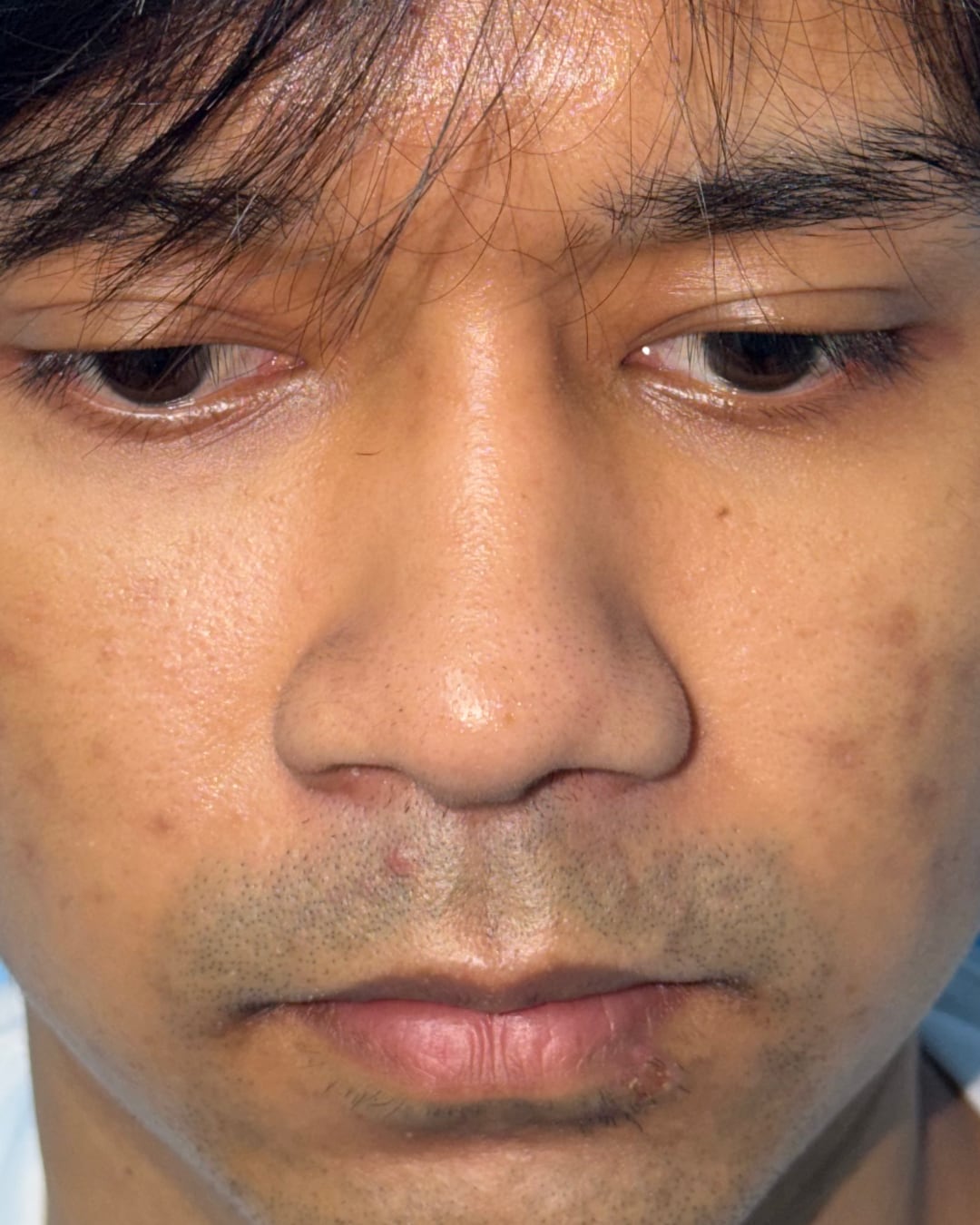 One year after primary open rhinoplasty with costal cartilage grafting, down view, Case 020