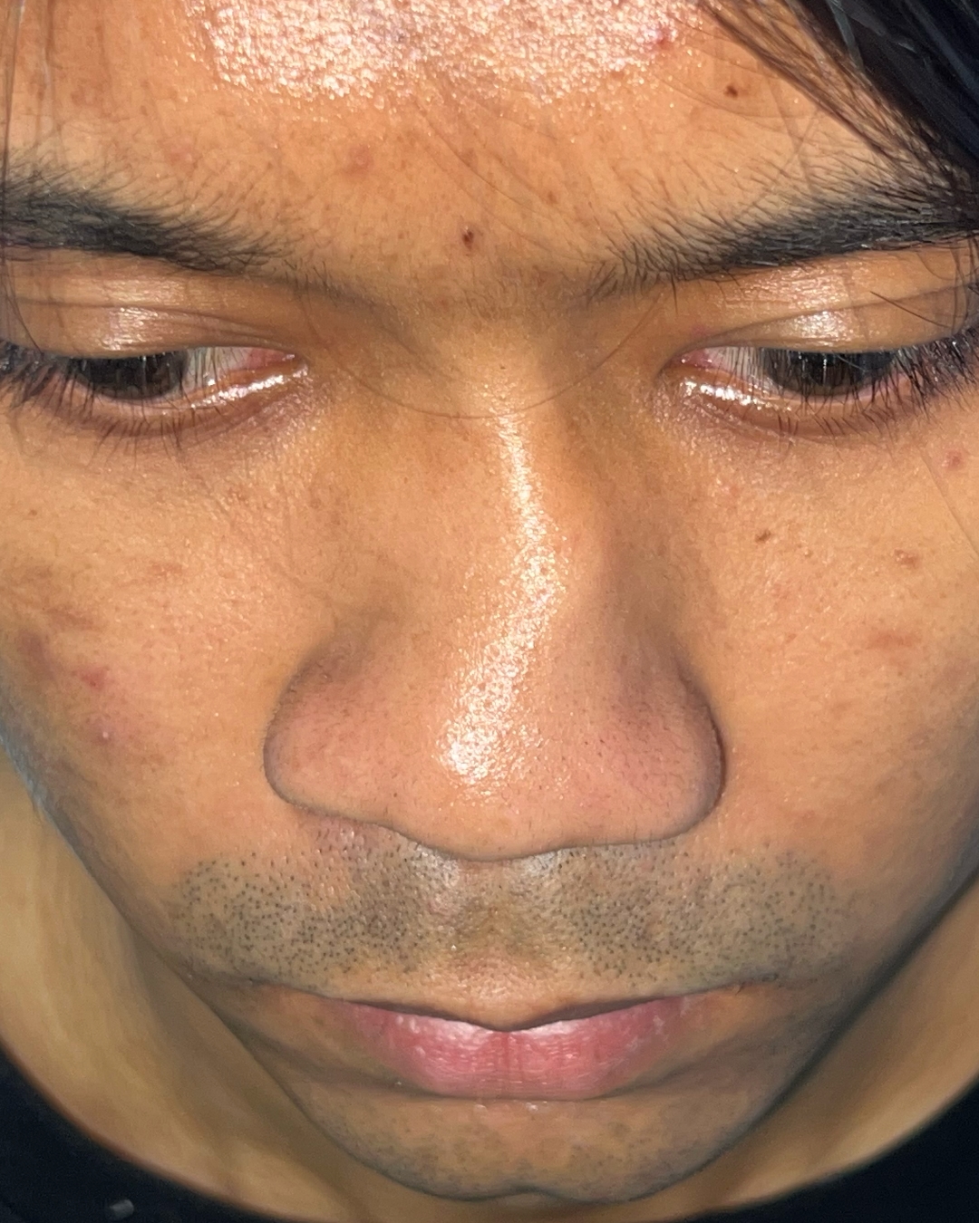 Before primary rhinoplasty for severe congenital nasal deviation, down view, Case 020