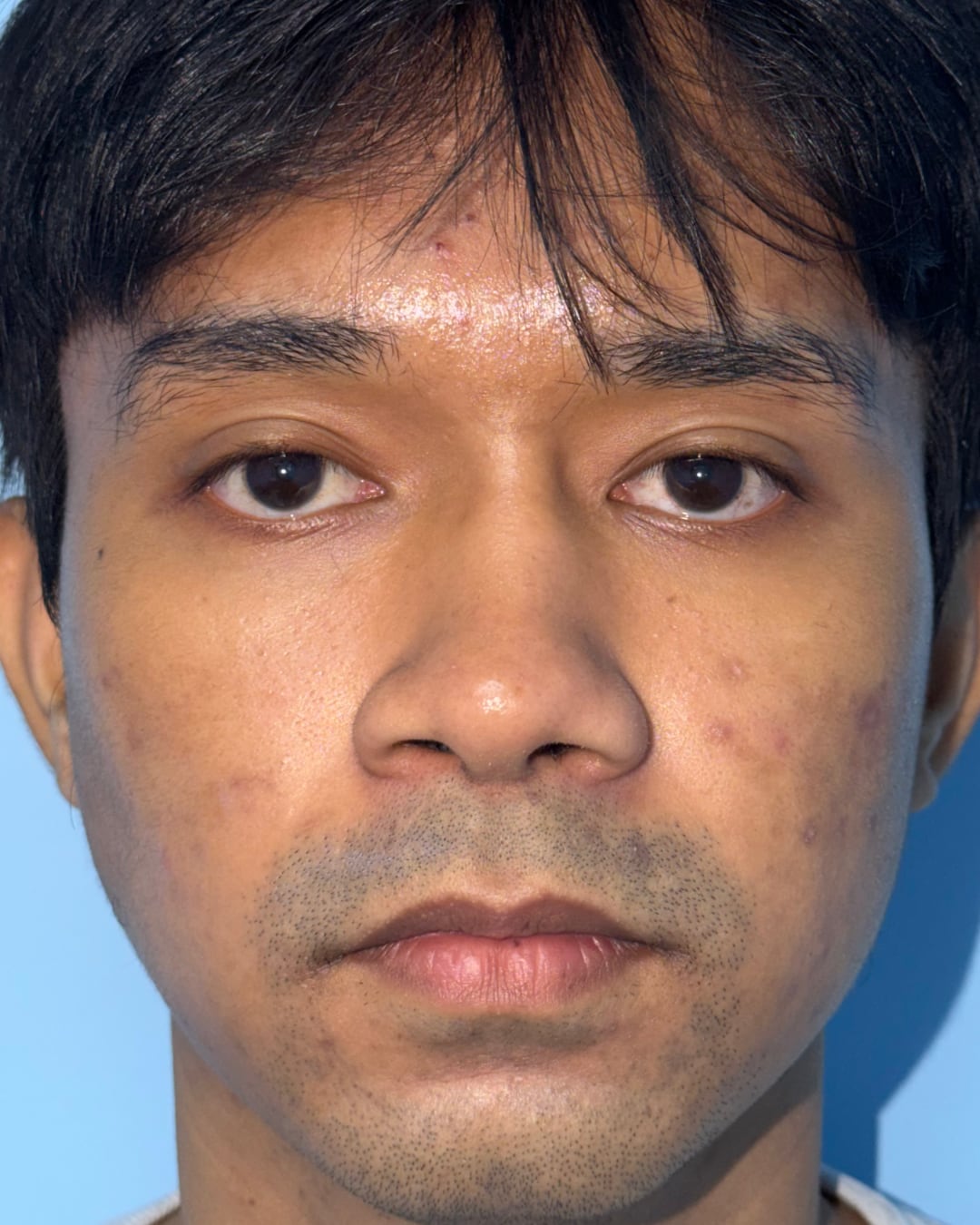 One year after primary open rhinoplasty with costal cartilage grafting, front view, Case 020