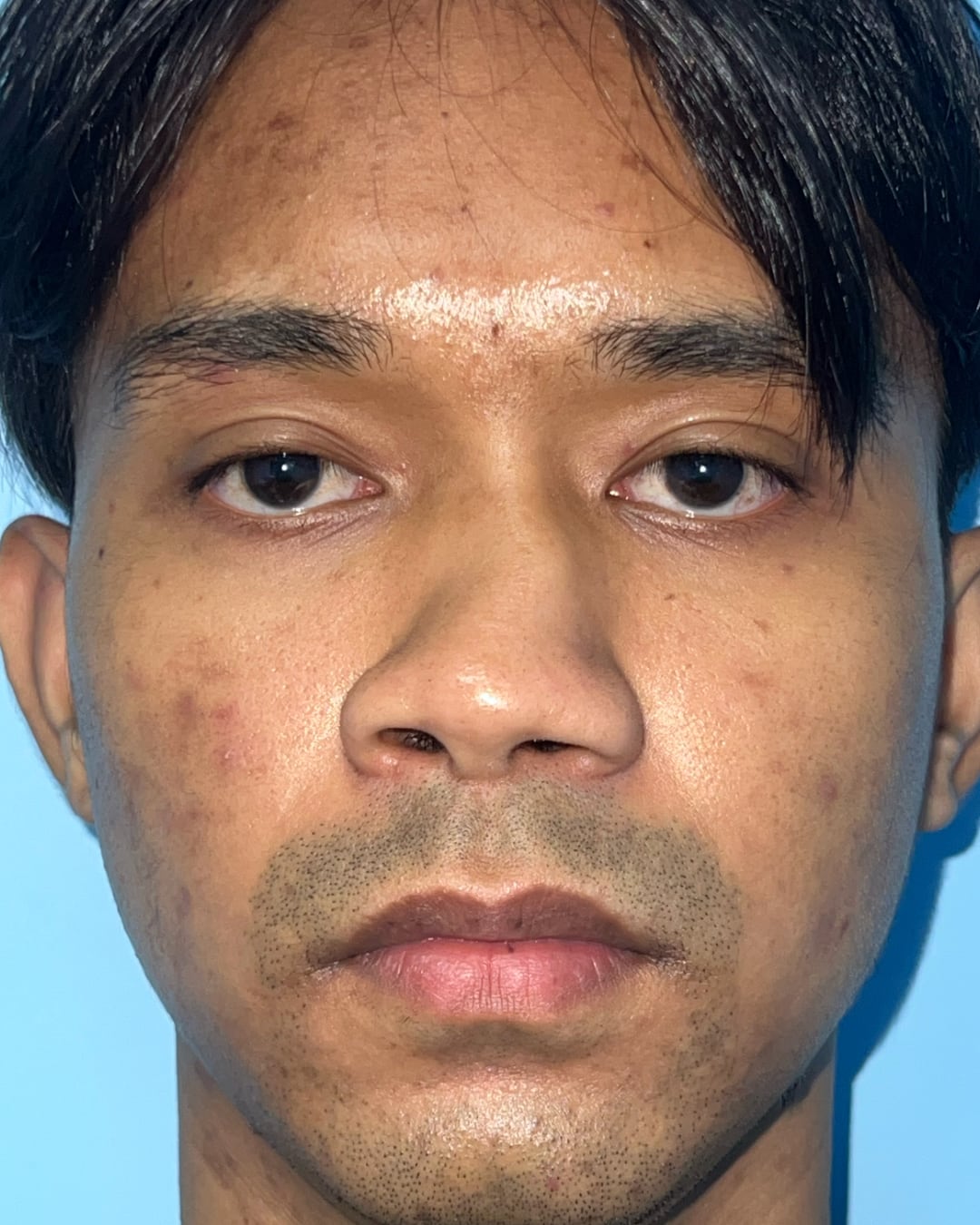 Before primary rhinoplasty for severe congenital nasal deviation, front view, Case 020