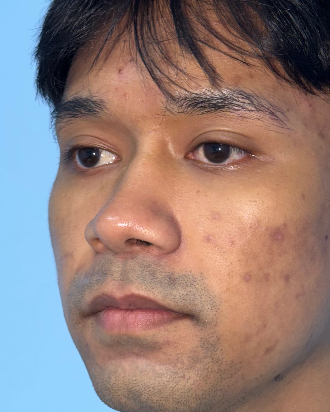 One year after primary open rhinoplasty with costal cartilage grafting, left oblique view, Case 020