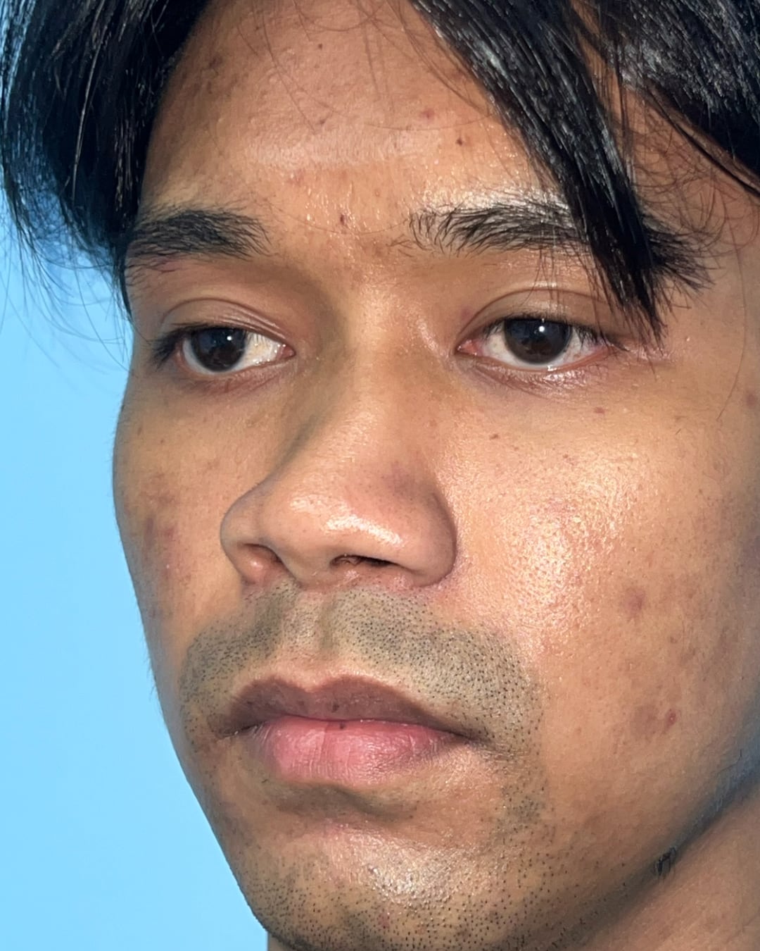 Before primary rhinoplasty for severe congenital nasal deviation, left oblique view, Case 020