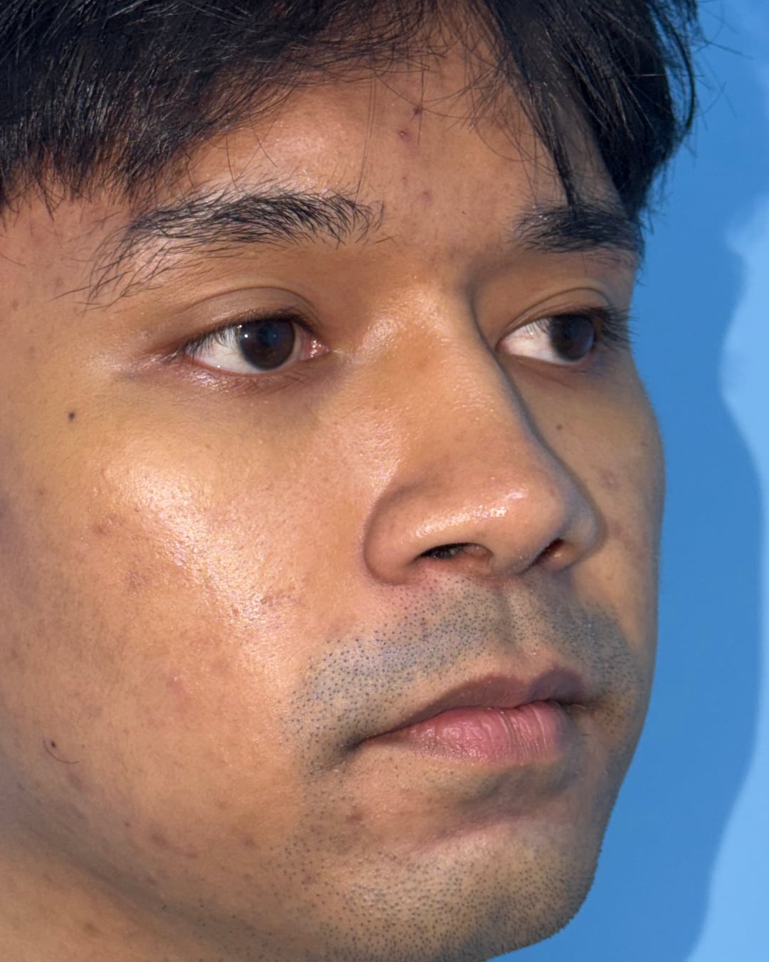 One year after primary open rhinoplasty with costal cartilage grafting, right oblique view, Case 020