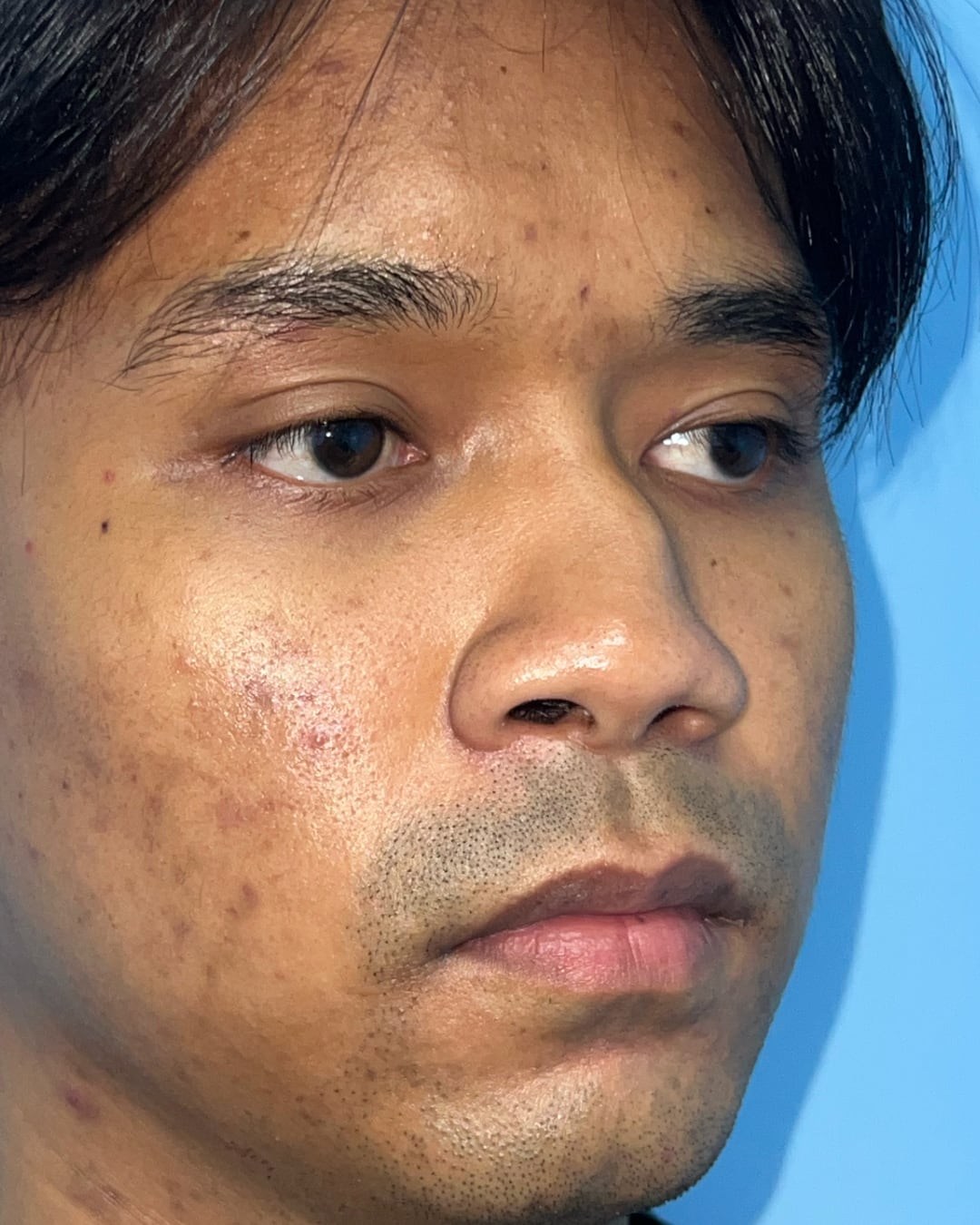 Before primary rhinoplasty for severe congenital nasal deviation, right oblique view, Case 020