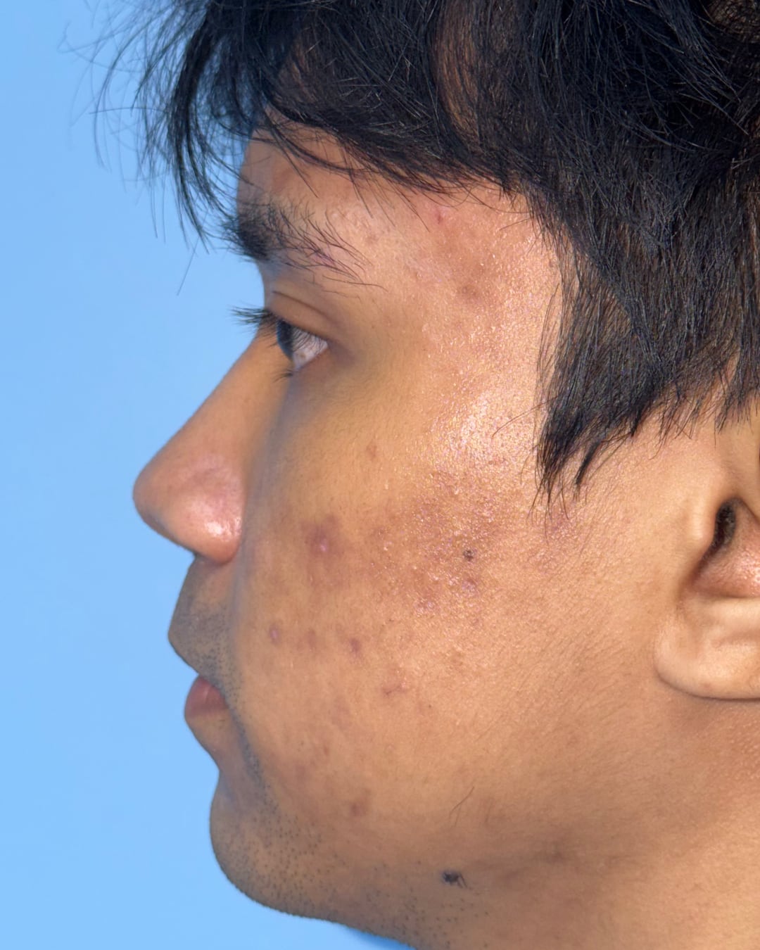 One year after primary open rhinoplasty with costal cartilage grafting, left profile view, Case 020