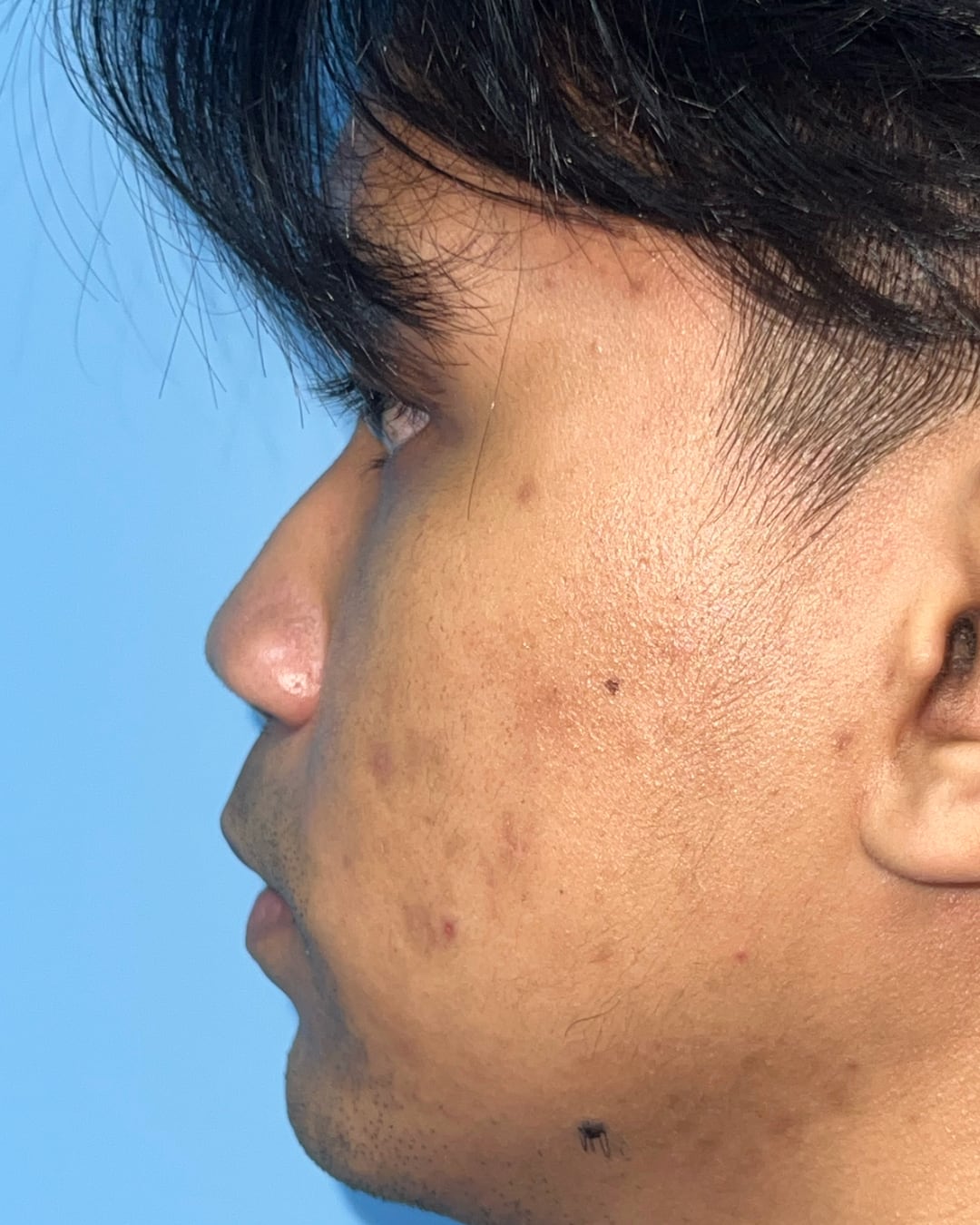Before primary rhinoplasty for severe congenital nasal deviation, left profile view, Case 020