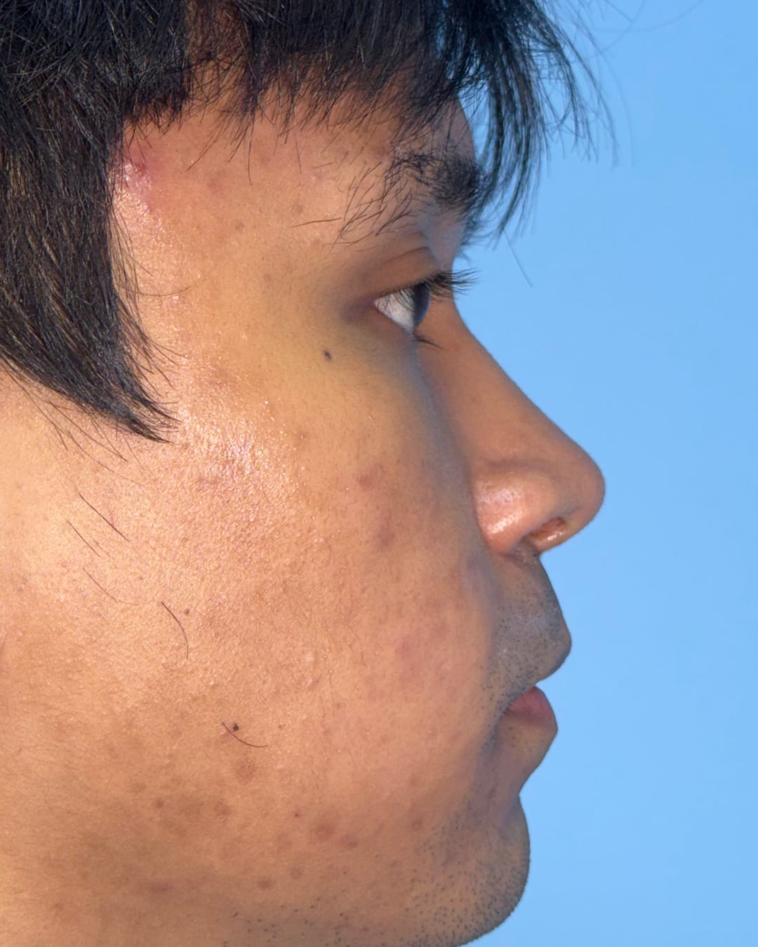 One year after primary open rhinoplasty with costal cartilage grafting, right profile view, Case 020