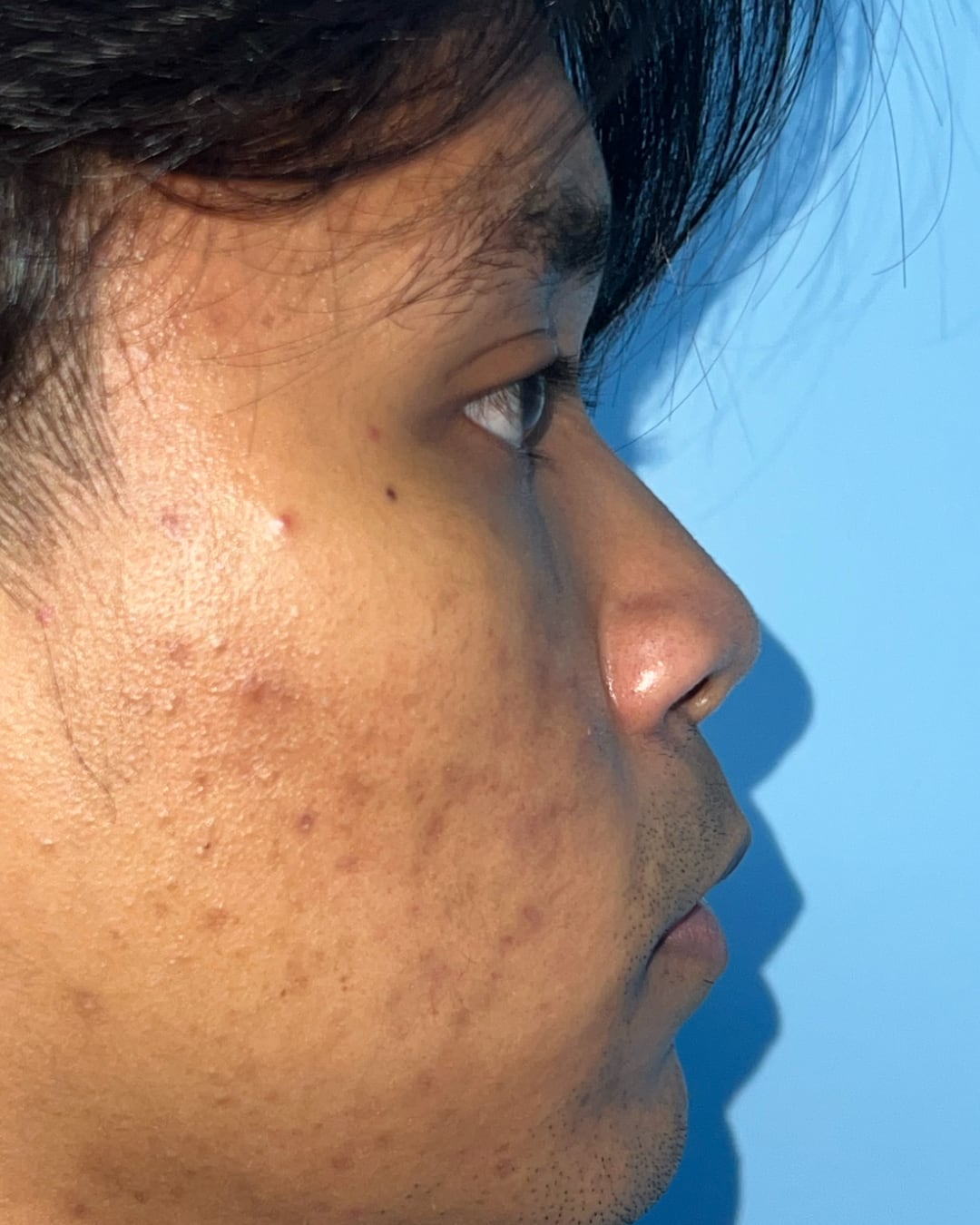Before primary rhinoplasty for severe congenital nasal deviation, right profile view, Case 020