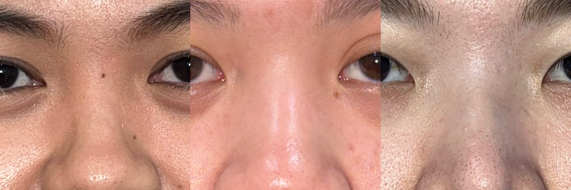 Clinical example showing a low nasal bridge