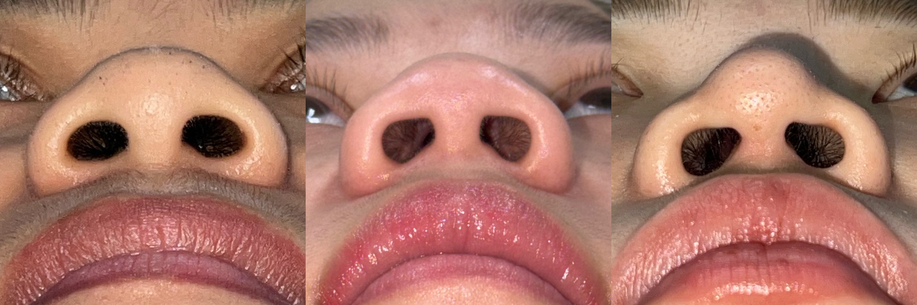 Clinical example showing a low profile nose in basal view with alar flare