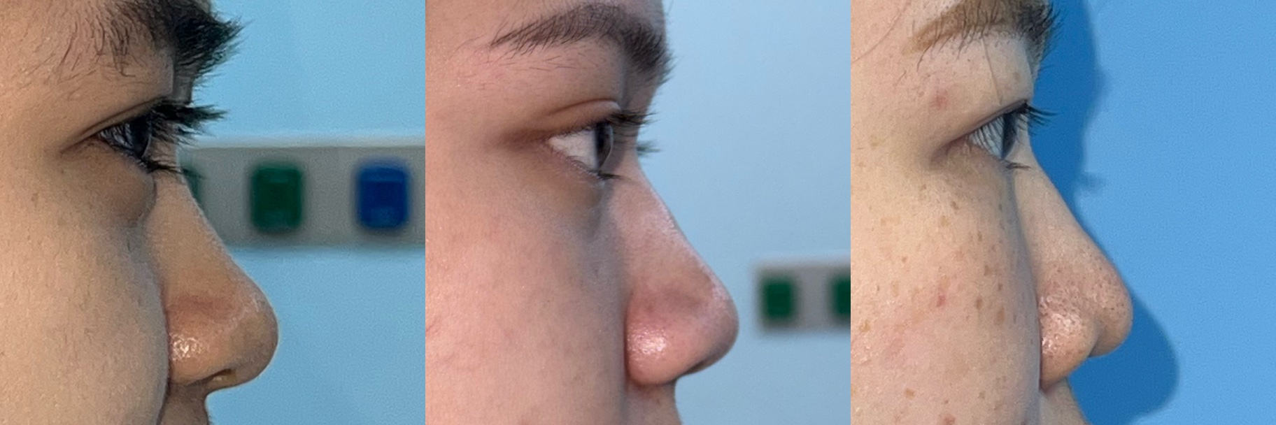 Clinical example showing a low profile nose