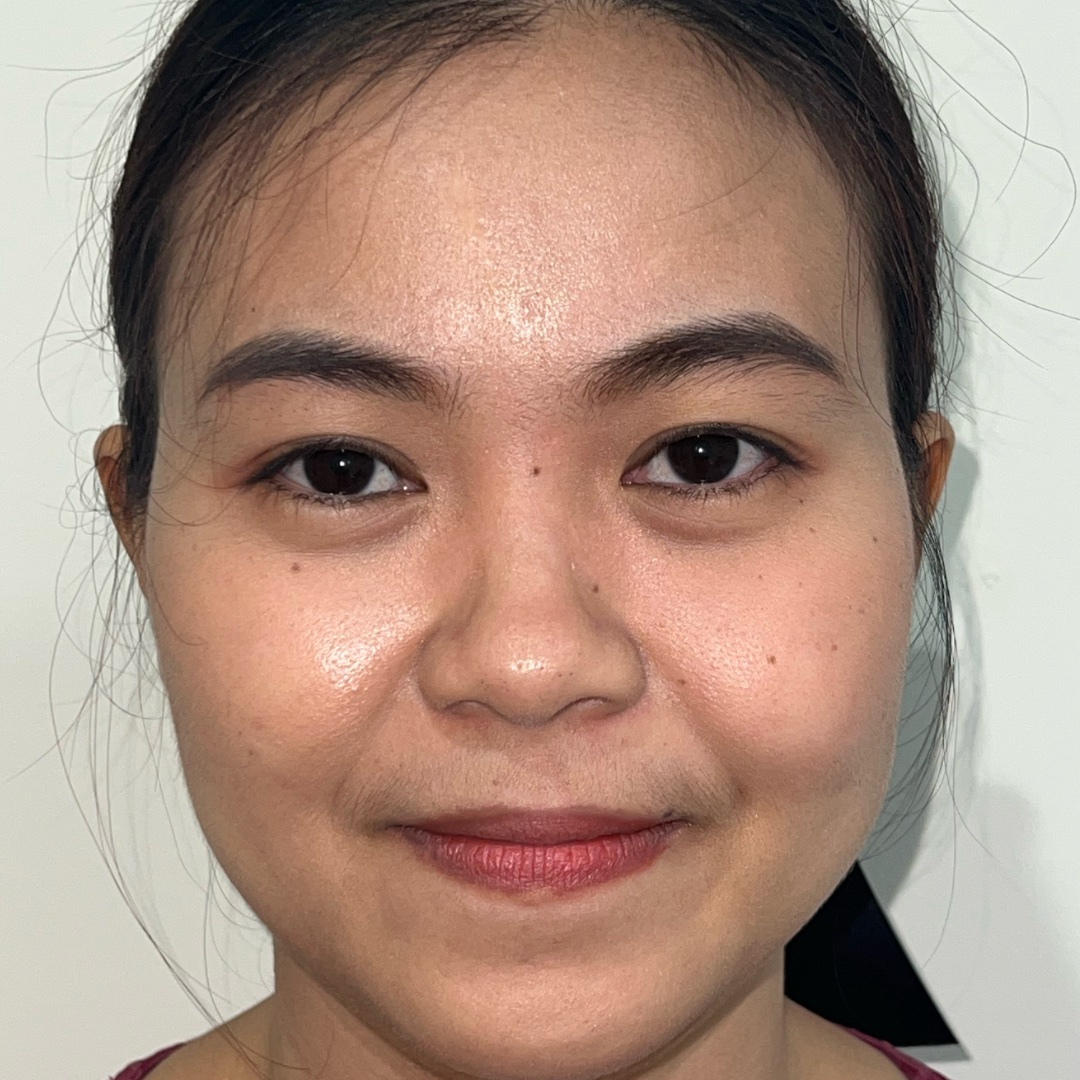 Preoperative view before primary rhinoplasty
