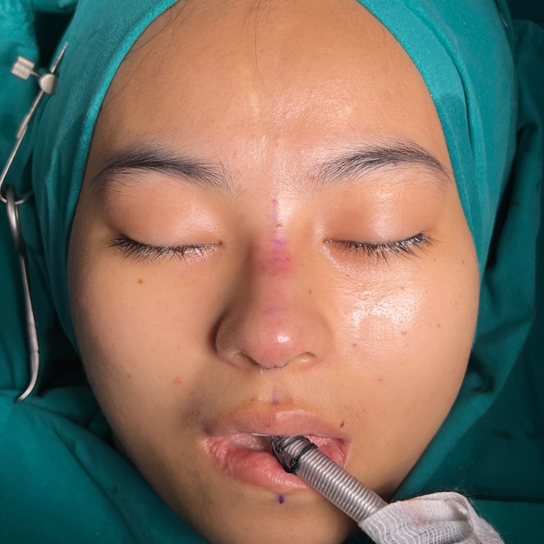 Immediate postoperative appearance after primary rhinoplasty on day 0