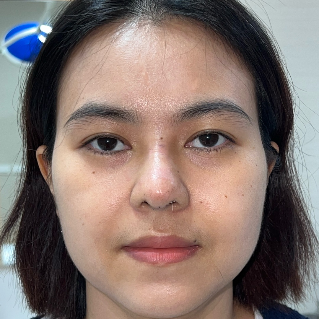 Primary rhinoplasty recovery at day 7