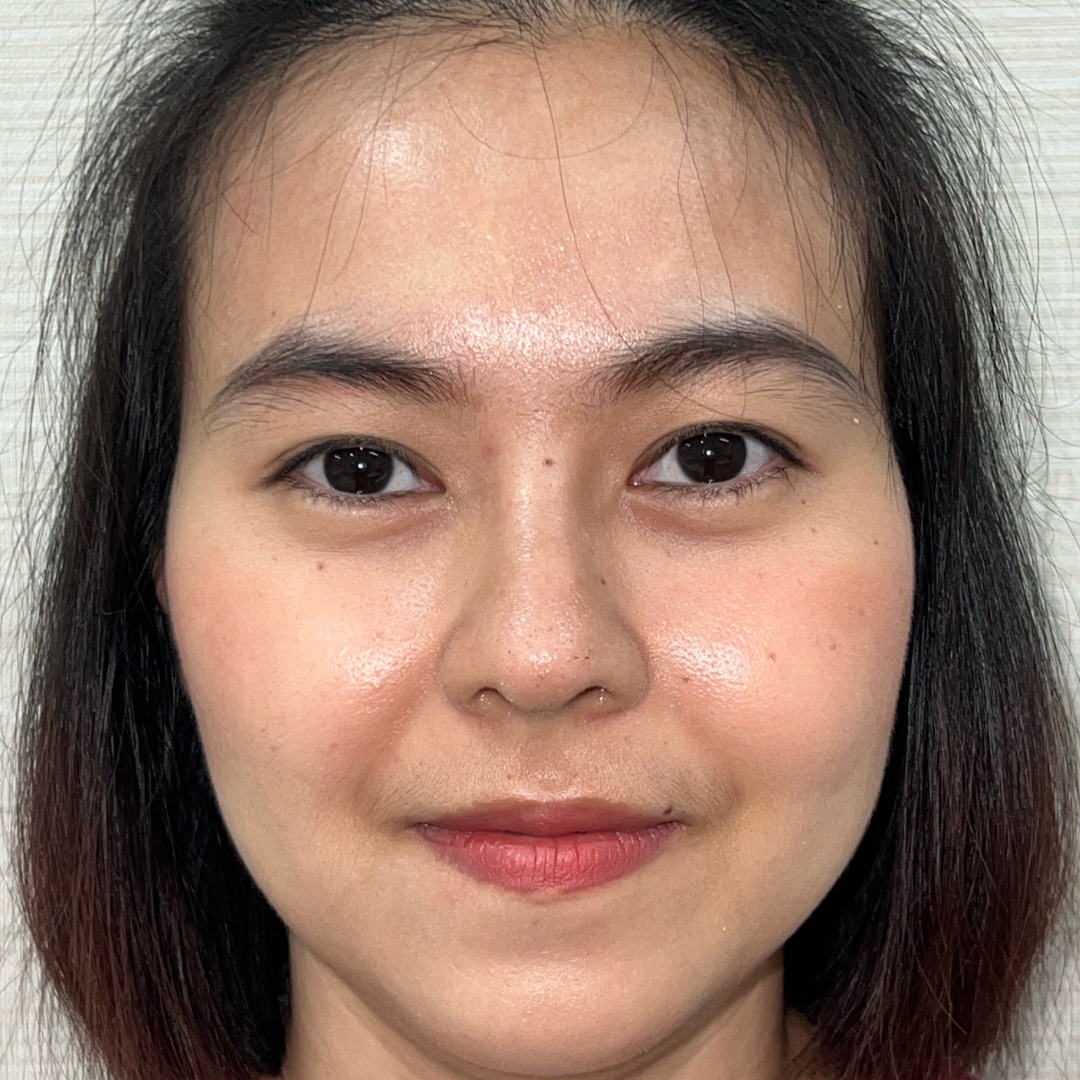 Primary rhinoplasty recovery at day 14