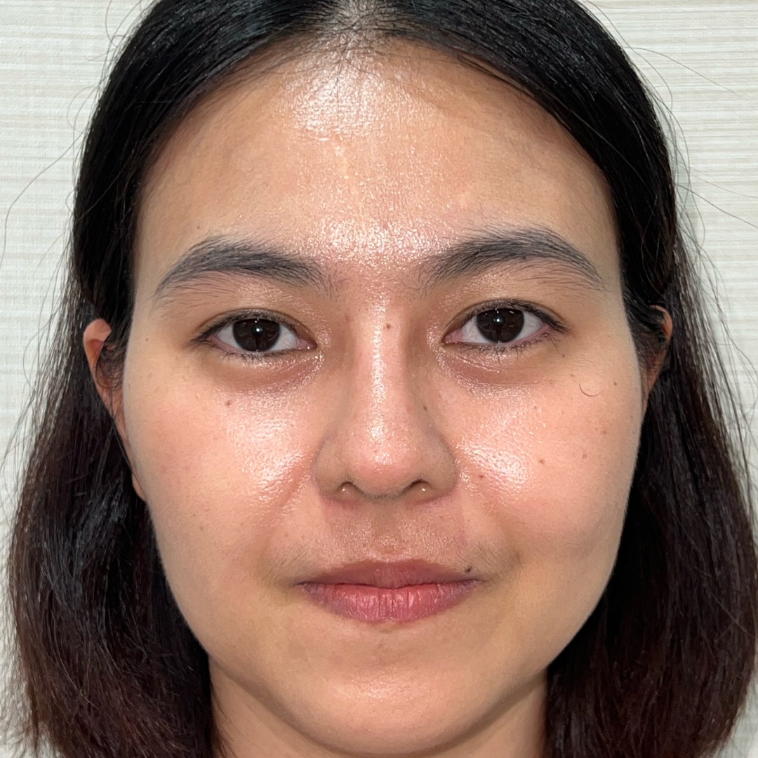 Primary rhinoplasty recovery at 1 month