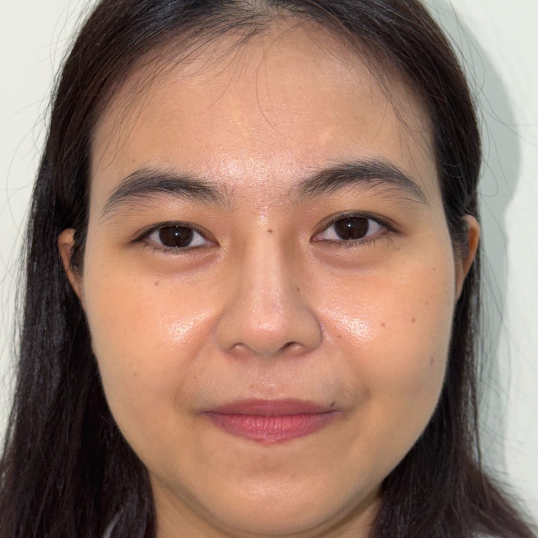 Primary rhinoplasty result at 13 months