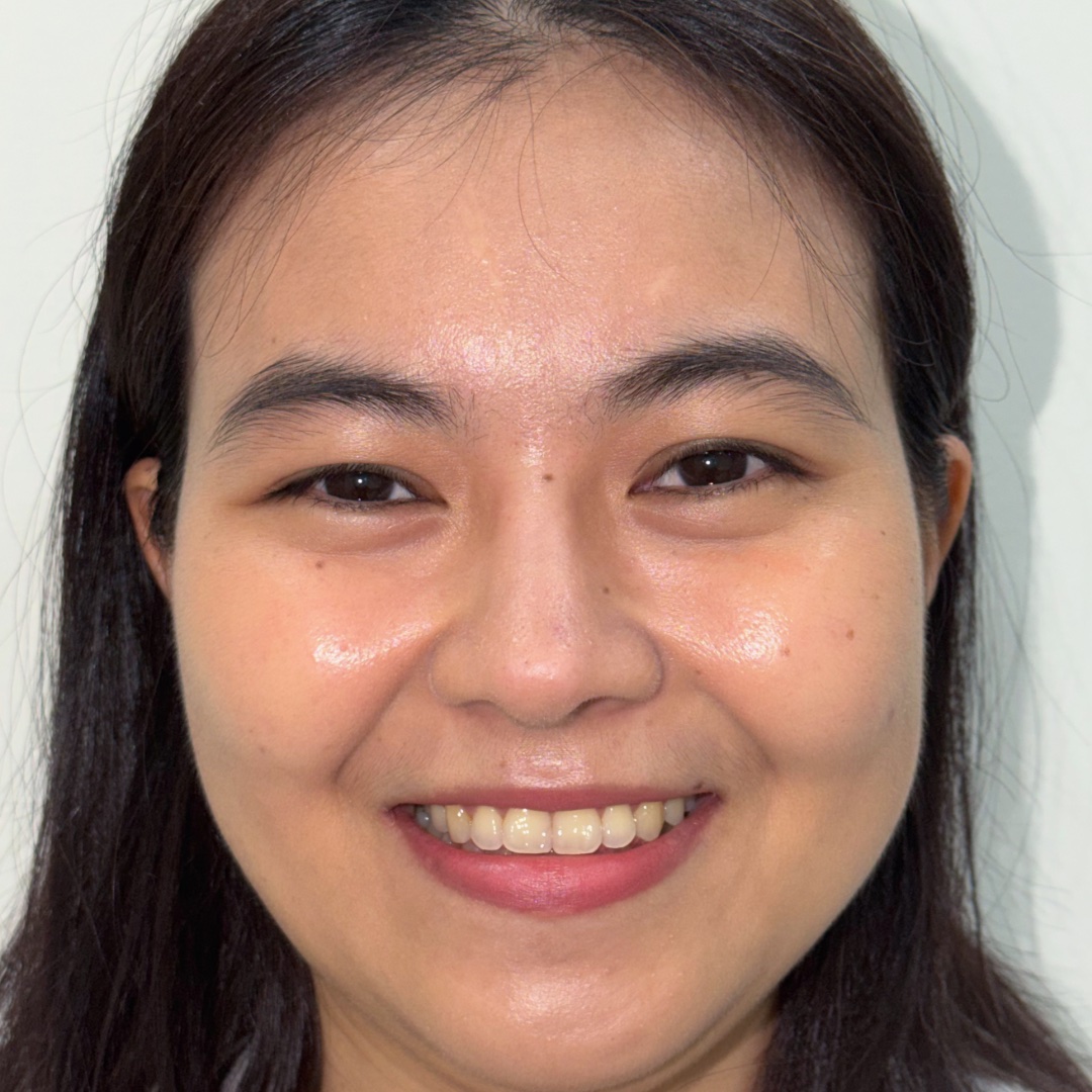 Primary rhinoplasty result at 13 months while smiling
