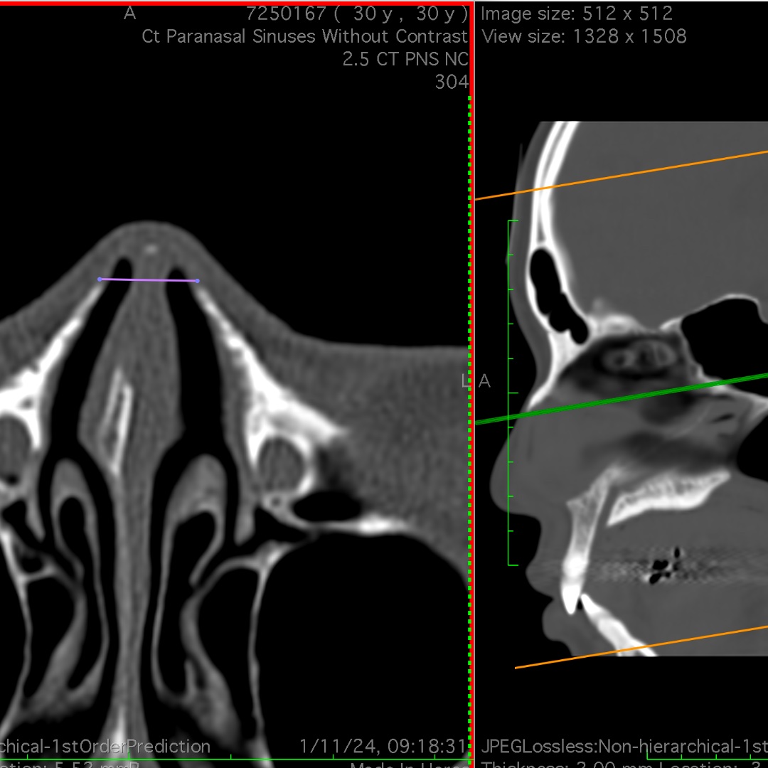 Surgical planning before primary rhinoplasty
