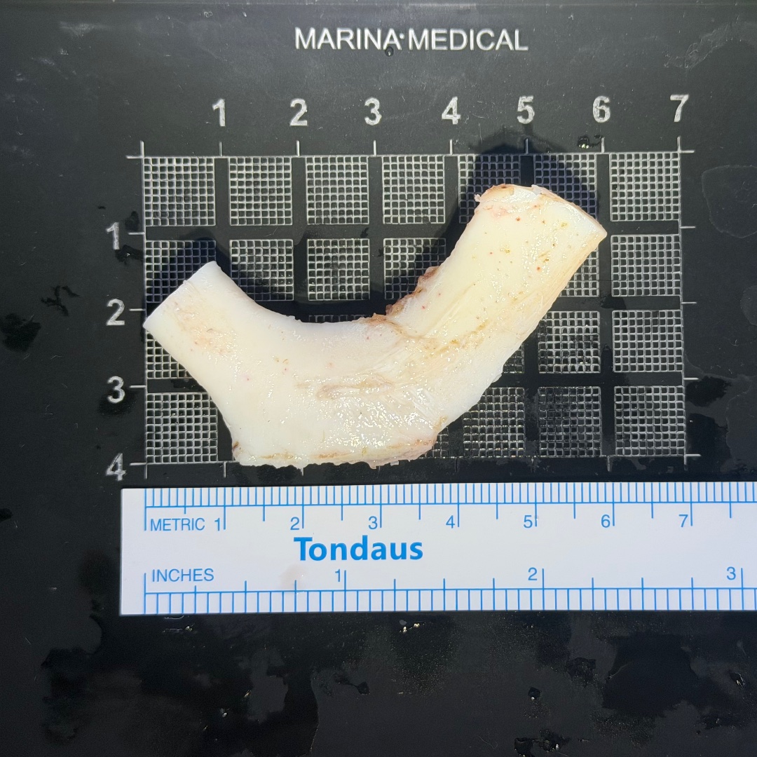 Costal cartilage harvest during rhinoplasty surgery