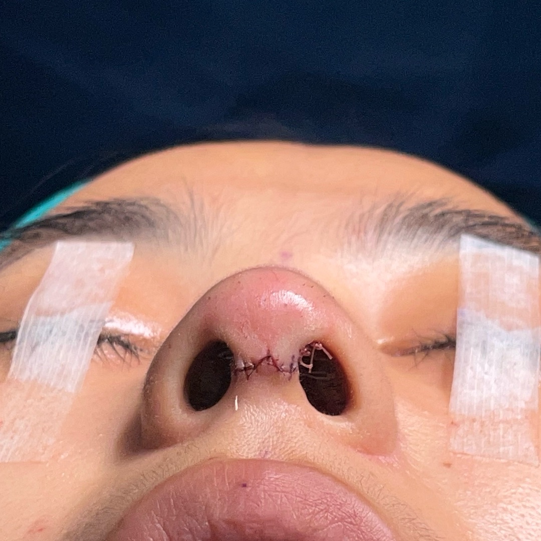Open rhinoplasty approach during surgery