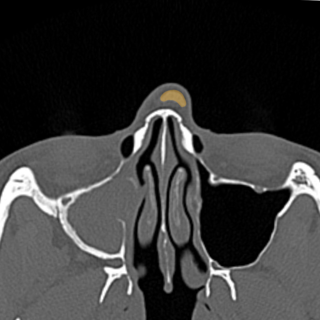 CT imaging demonstrating nasal deviation during preoperative revision rhinoplasty assessment