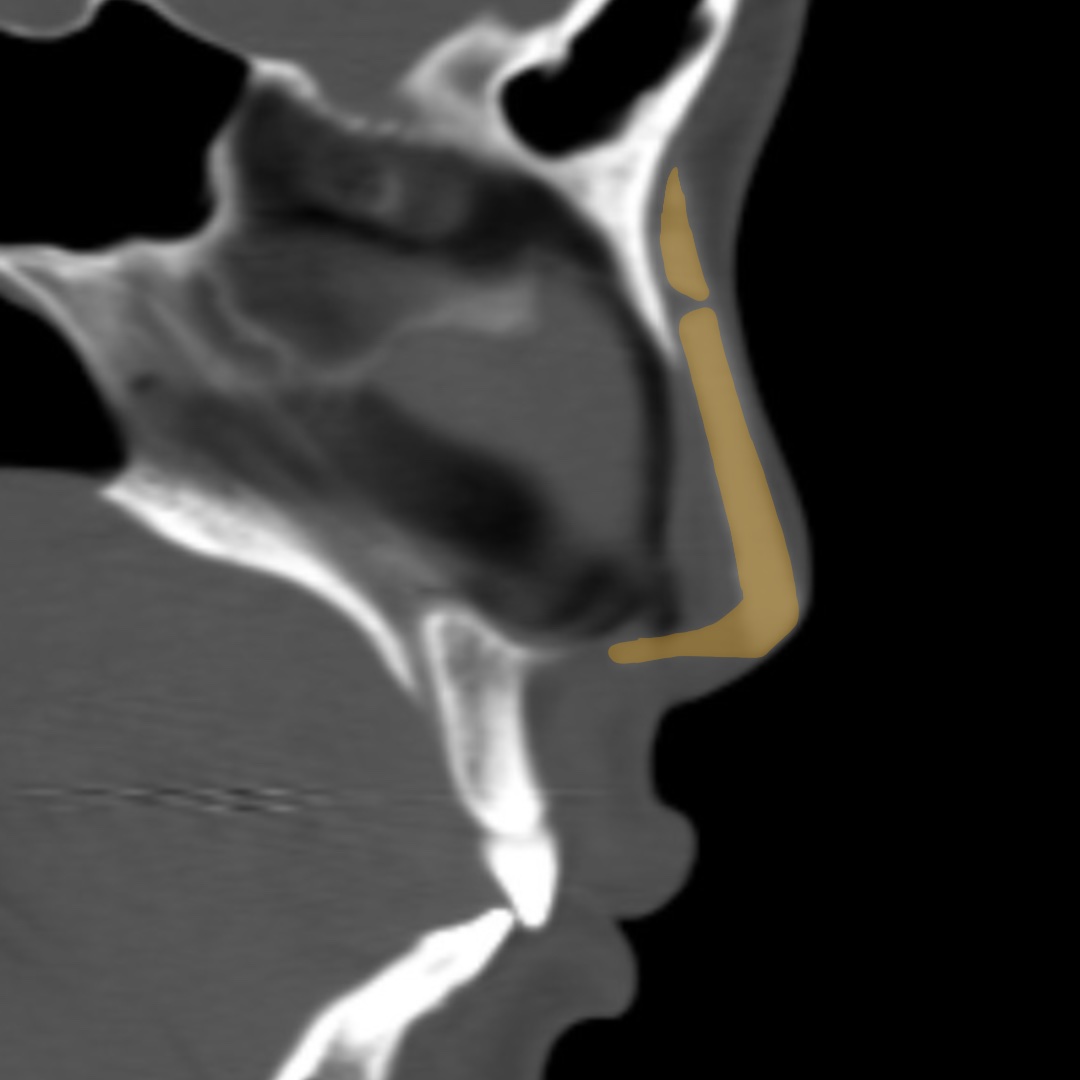 CT imaging demonstrating impending implant extrusion and implant malposition during preoperative revision rhinoplasty assessment