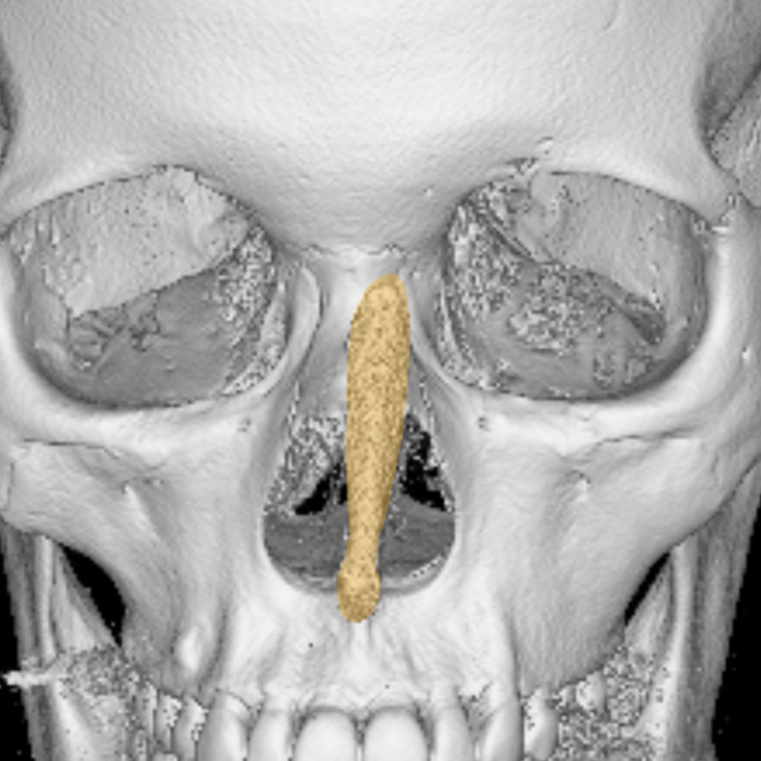Three-dimensional CT imaging demonstrating nasal implant deviation during preoperative revision rhinoplasty assessment