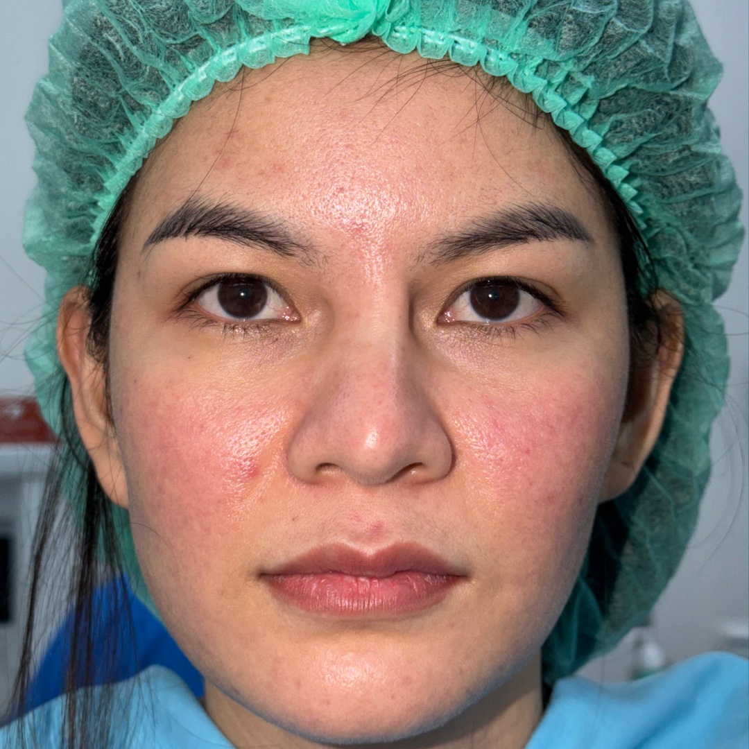Preoperative view before revision rhinoplasty with costal cartilage