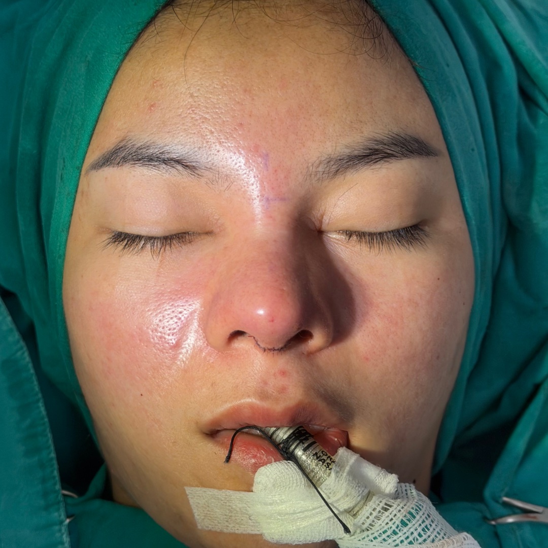 Immediate postoperative appearance after revision rhinoplasty with costal cartilage