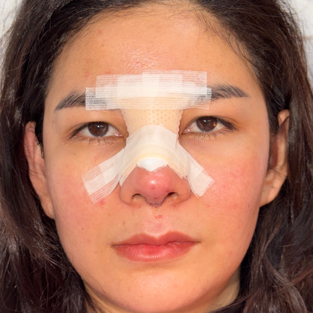 Recovery at day 1 after revision rhinoplasty with costal cartilage