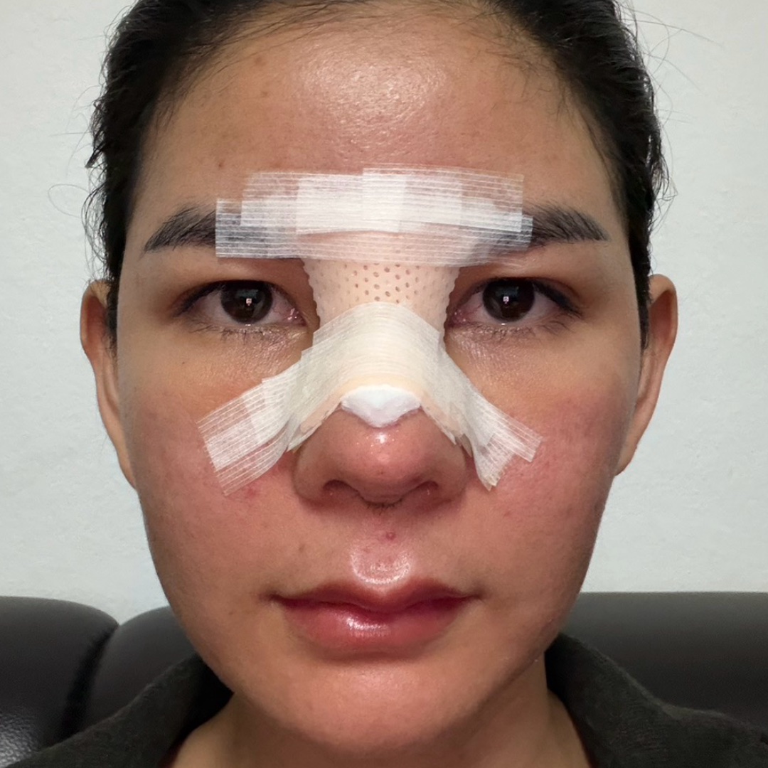 Recovery at day 2 after revision rhinoplasty with costal cartilage