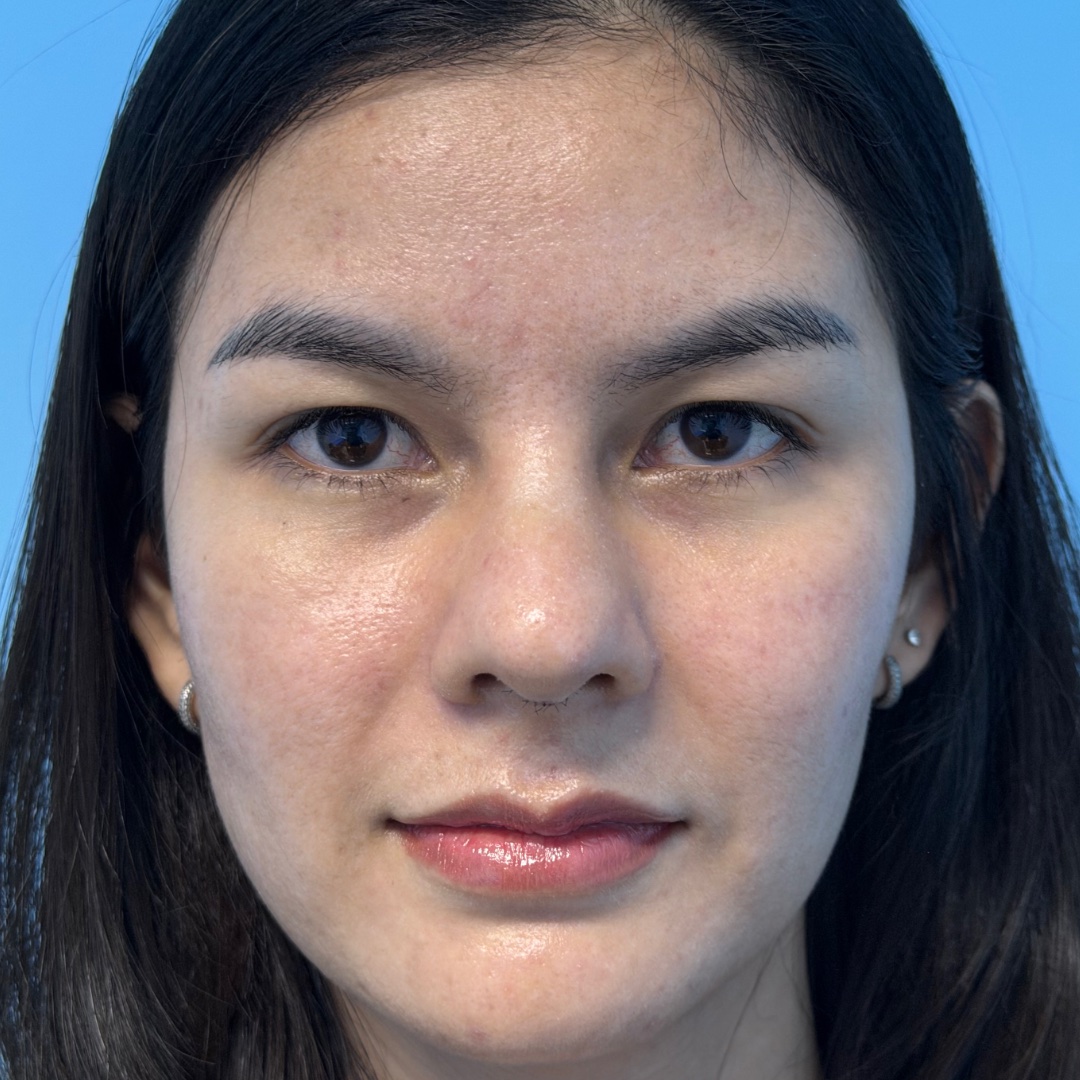 Recovery at day 12 after revision rhinoplasty with costal cartilage