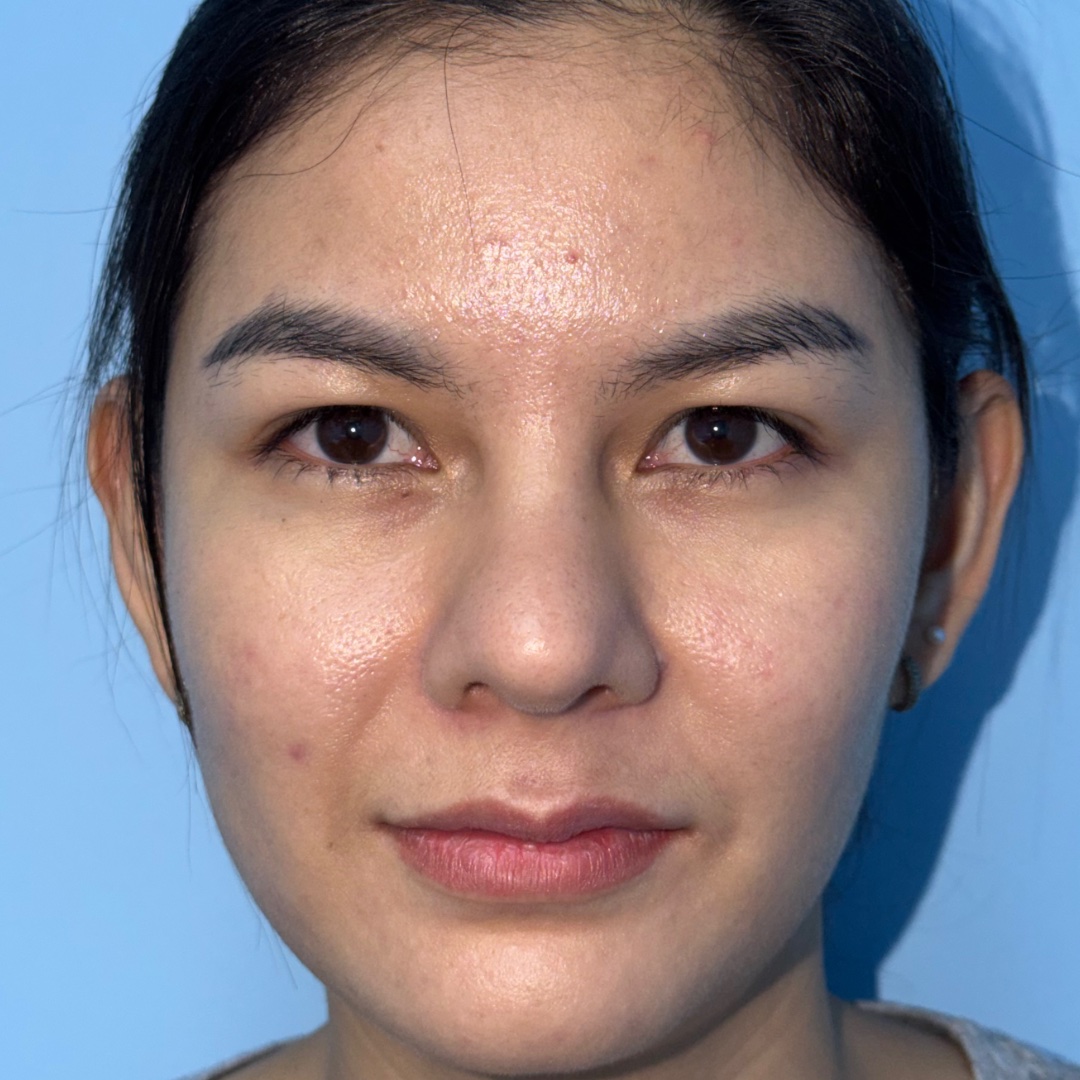 Recovery at 4 months after revision rhinoplasty with costal cartilage