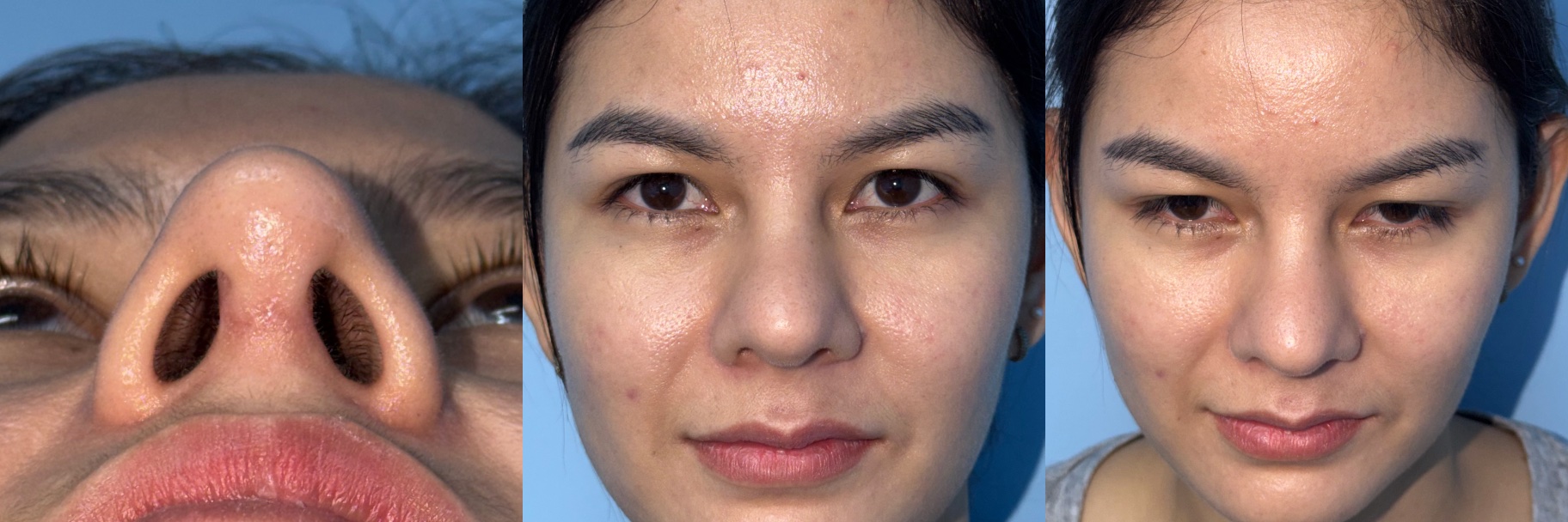 After revision rhinoplasty examples showing correction of nasal deviation after previous rhinoplasty