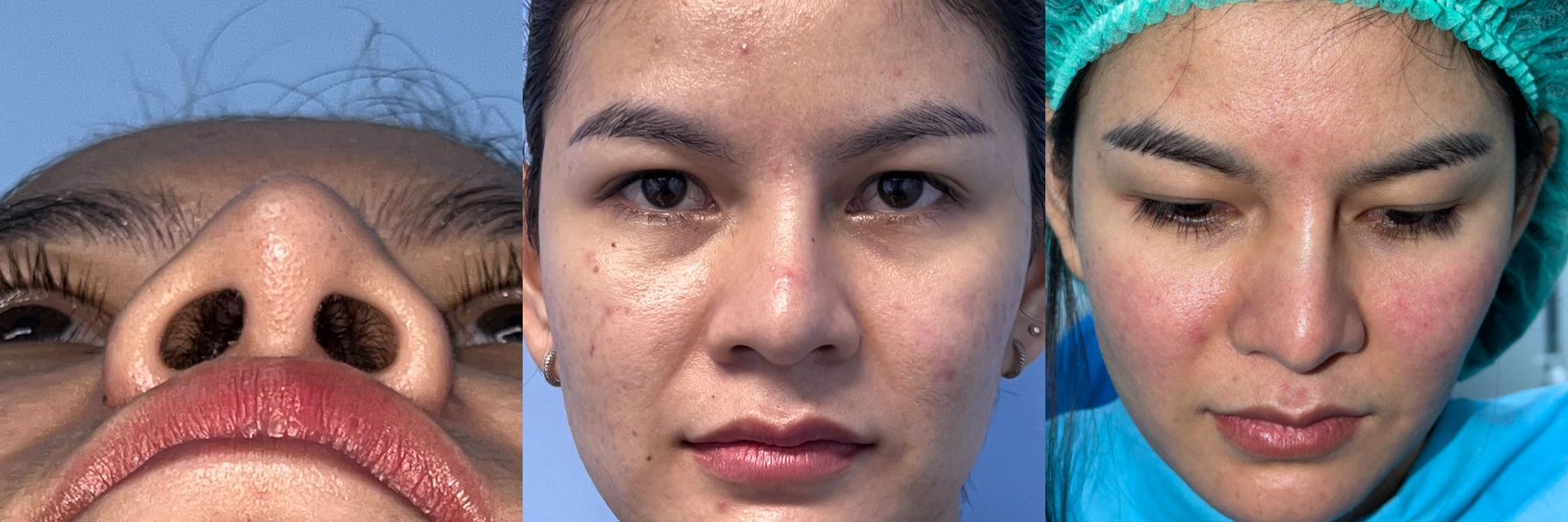 Before revision rhinoplasty examples showing nasal deviation after previous rhinoplasty