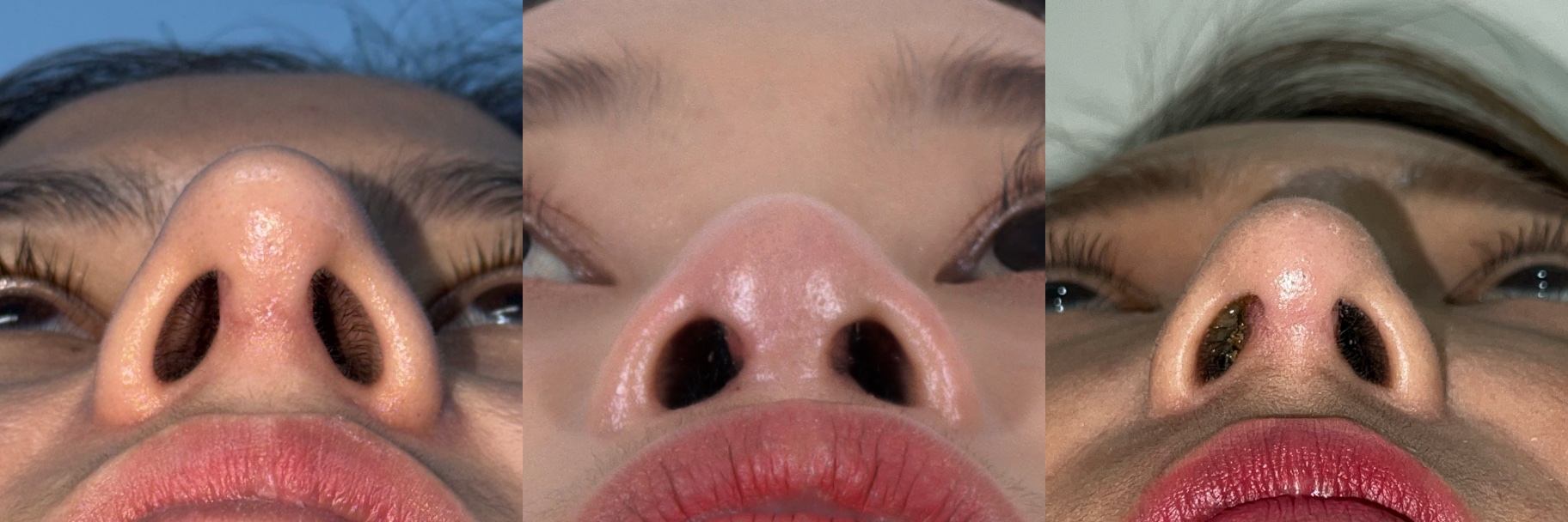 After revision rhinoplasty examples showing correction of tip deformity after previous rhinoplasty